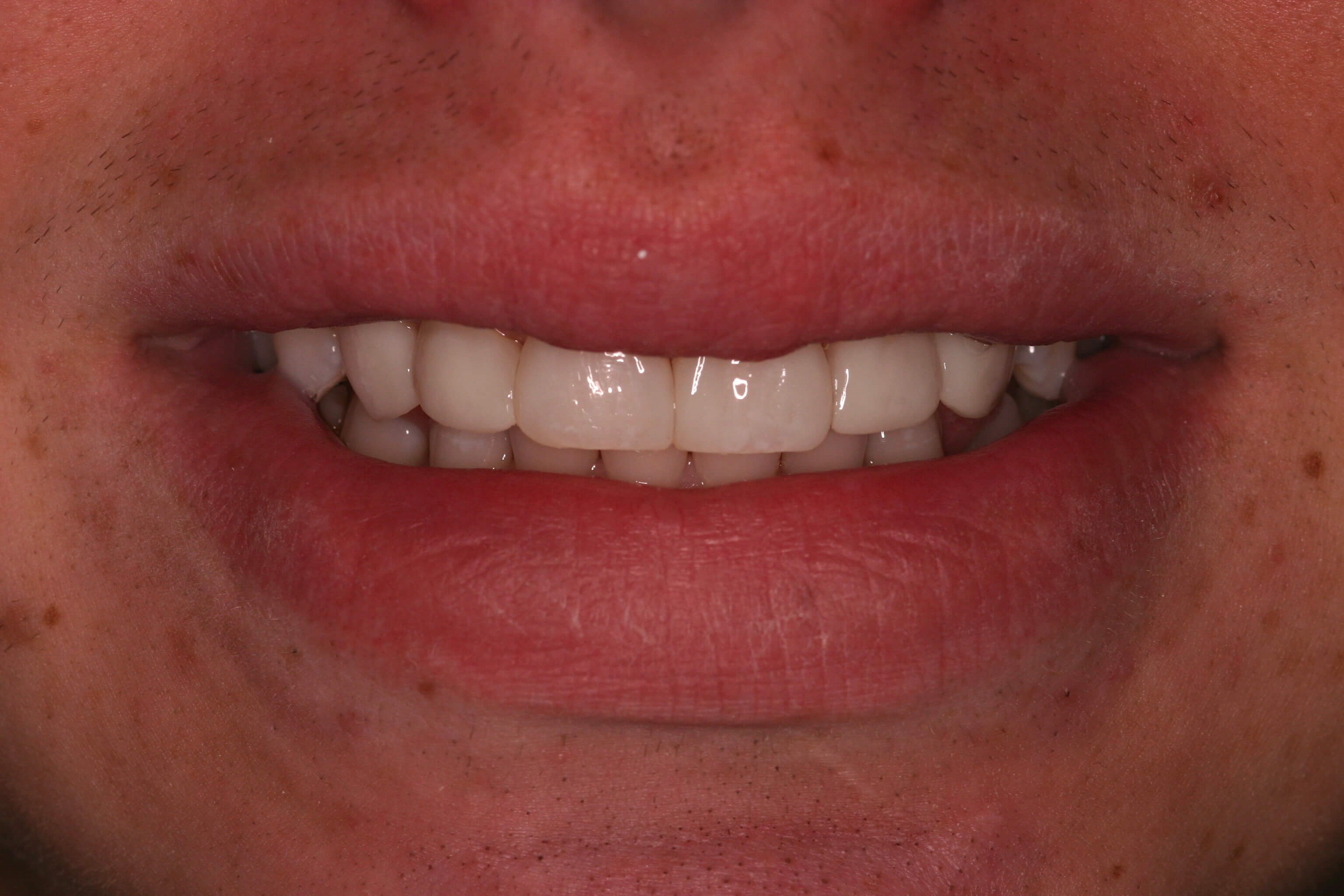 Spaces Closed / Smilemakeover After Bonding Spaces Closed / Smilemakeover After Bonding