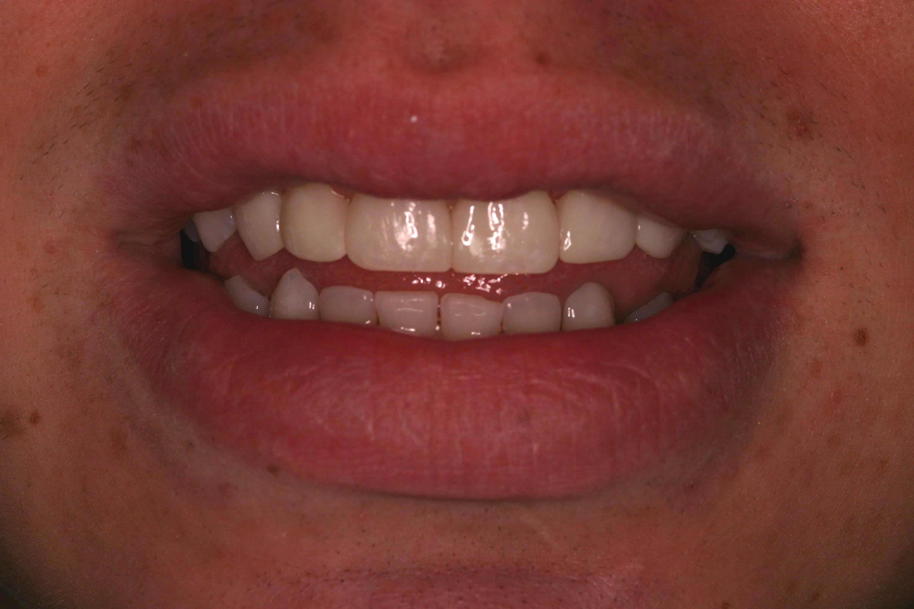 Bonding Before and After After Bonding Before and After After