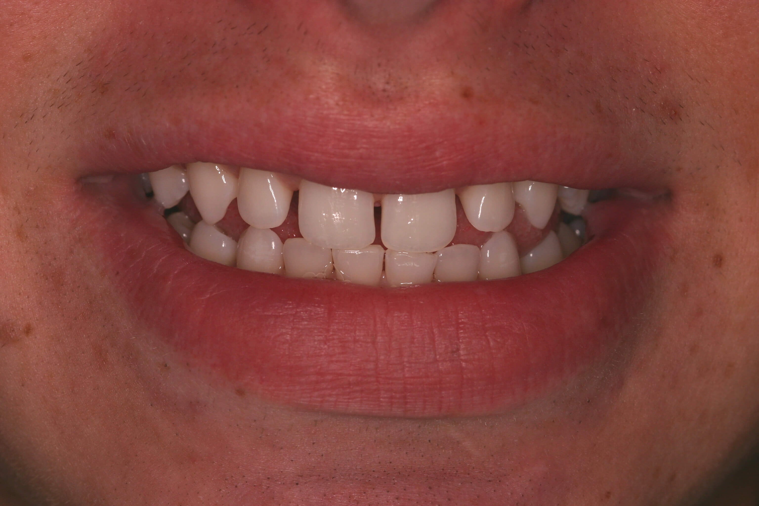 Bonding Before and After Before Bonding Before and After Before