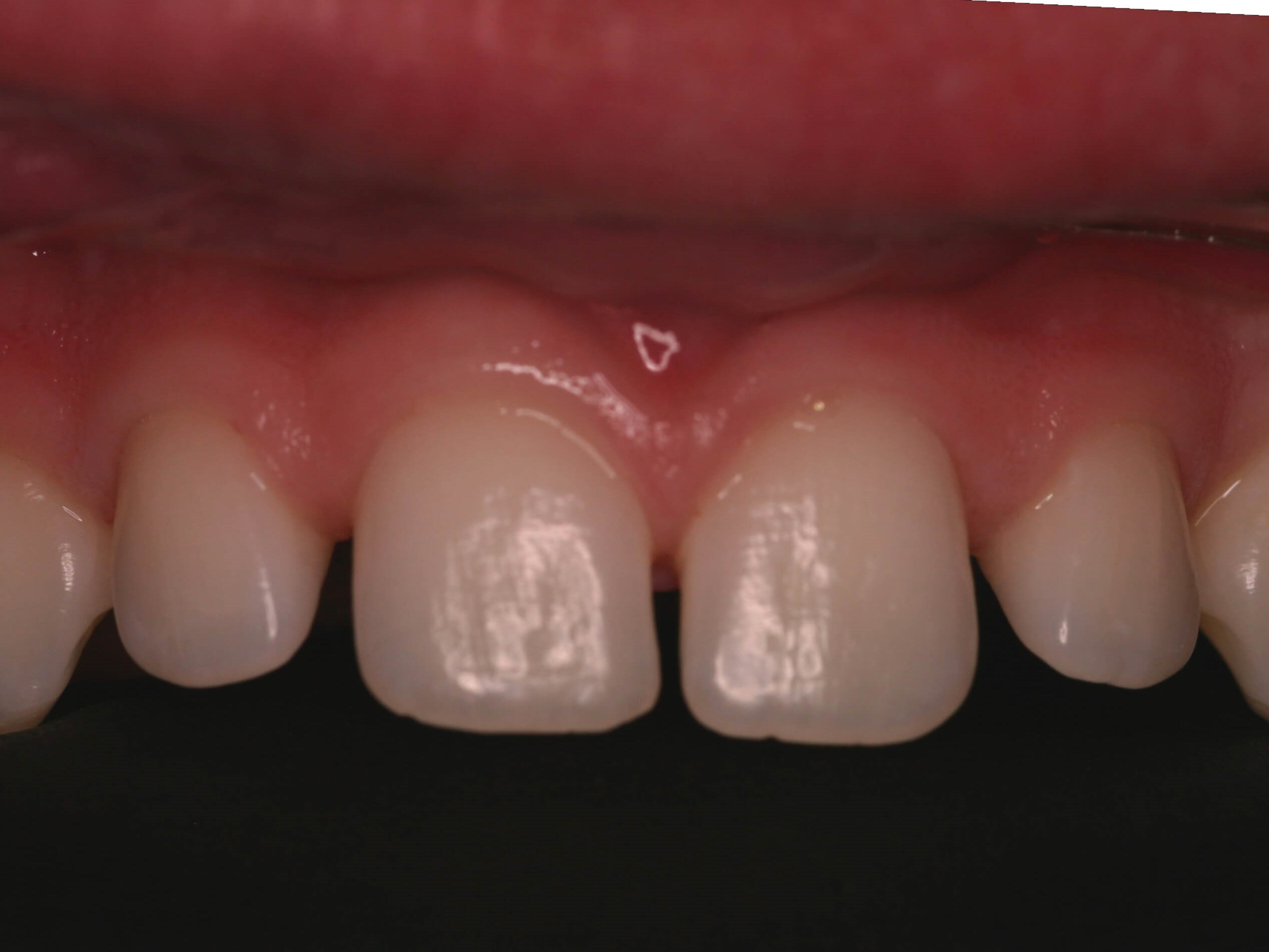 Bonding Before and After Before Close up Bonding Before and After Before Close up