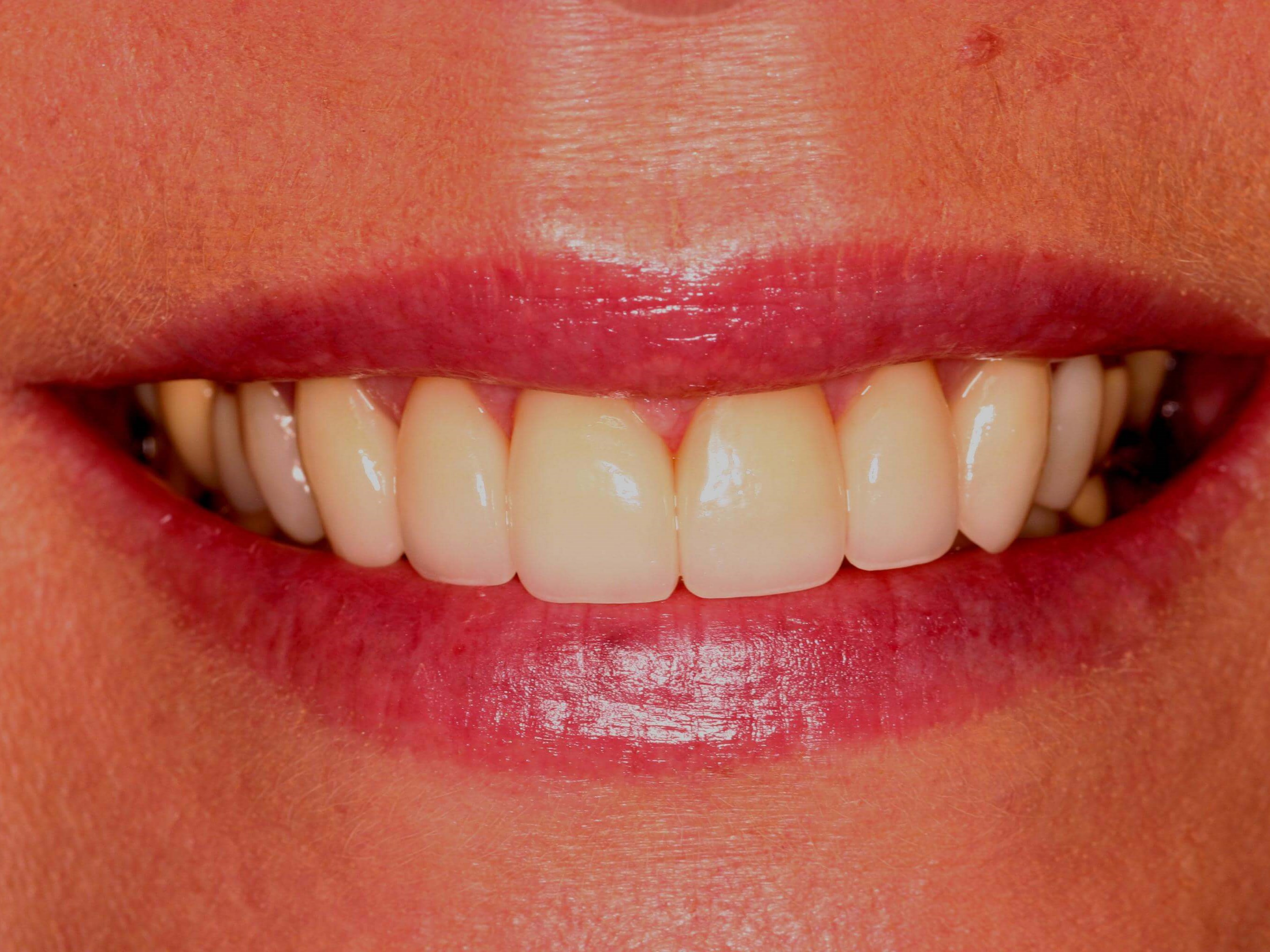 Smile Makeover After