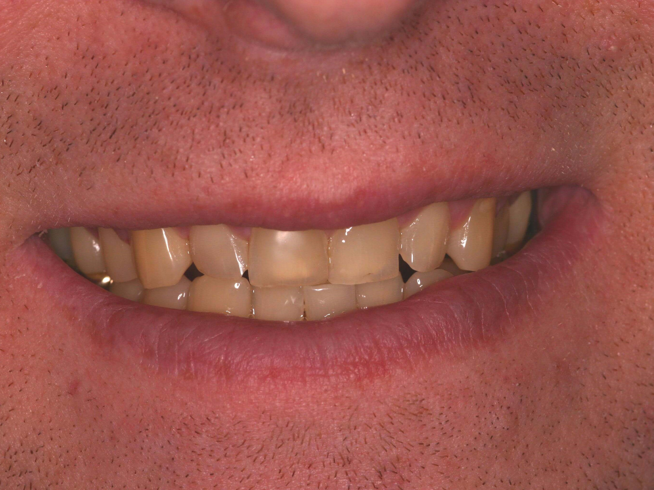 Smile Makeover Before
