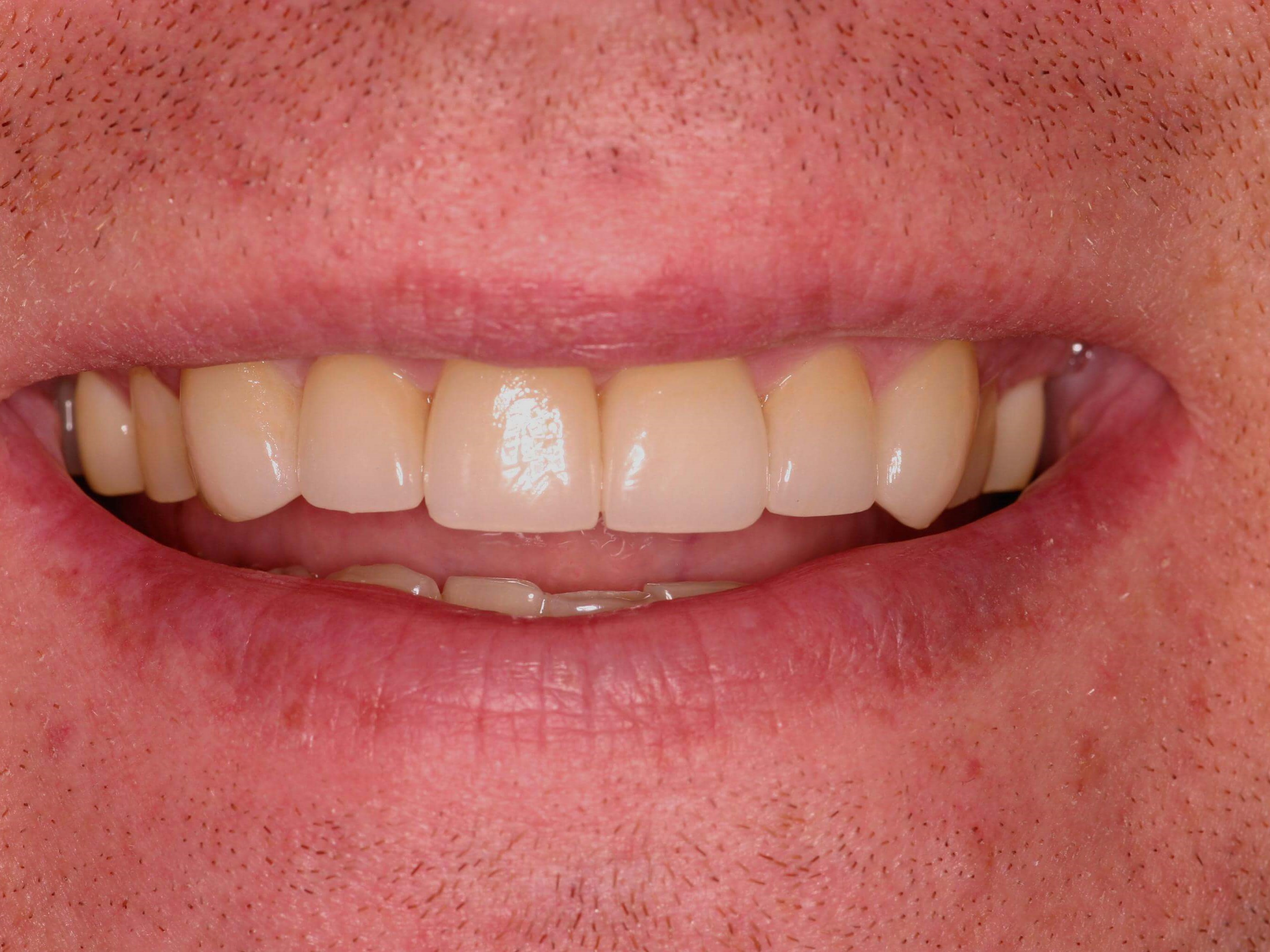 Smile Makeover After