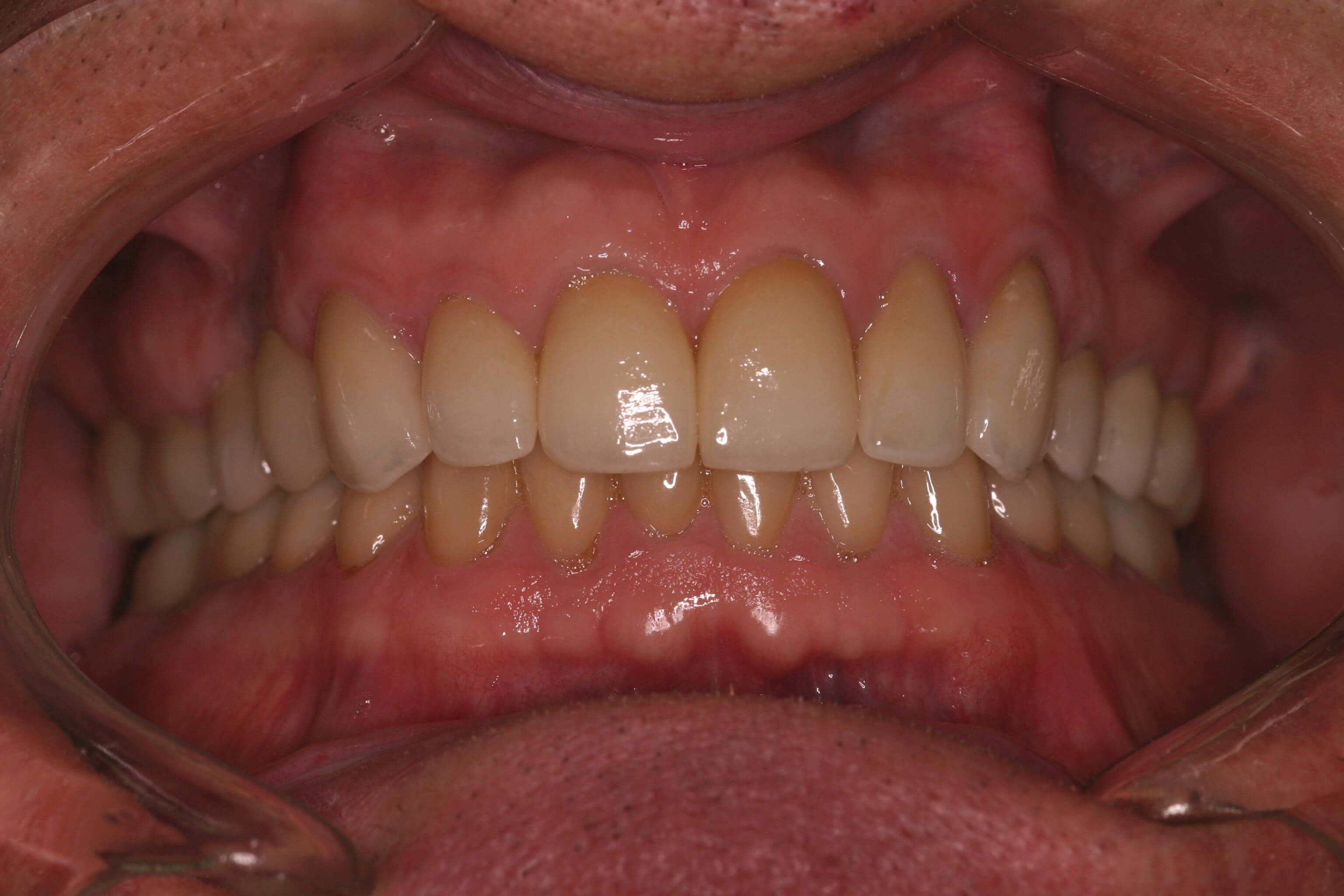 Before and After Dental Crowns Photos