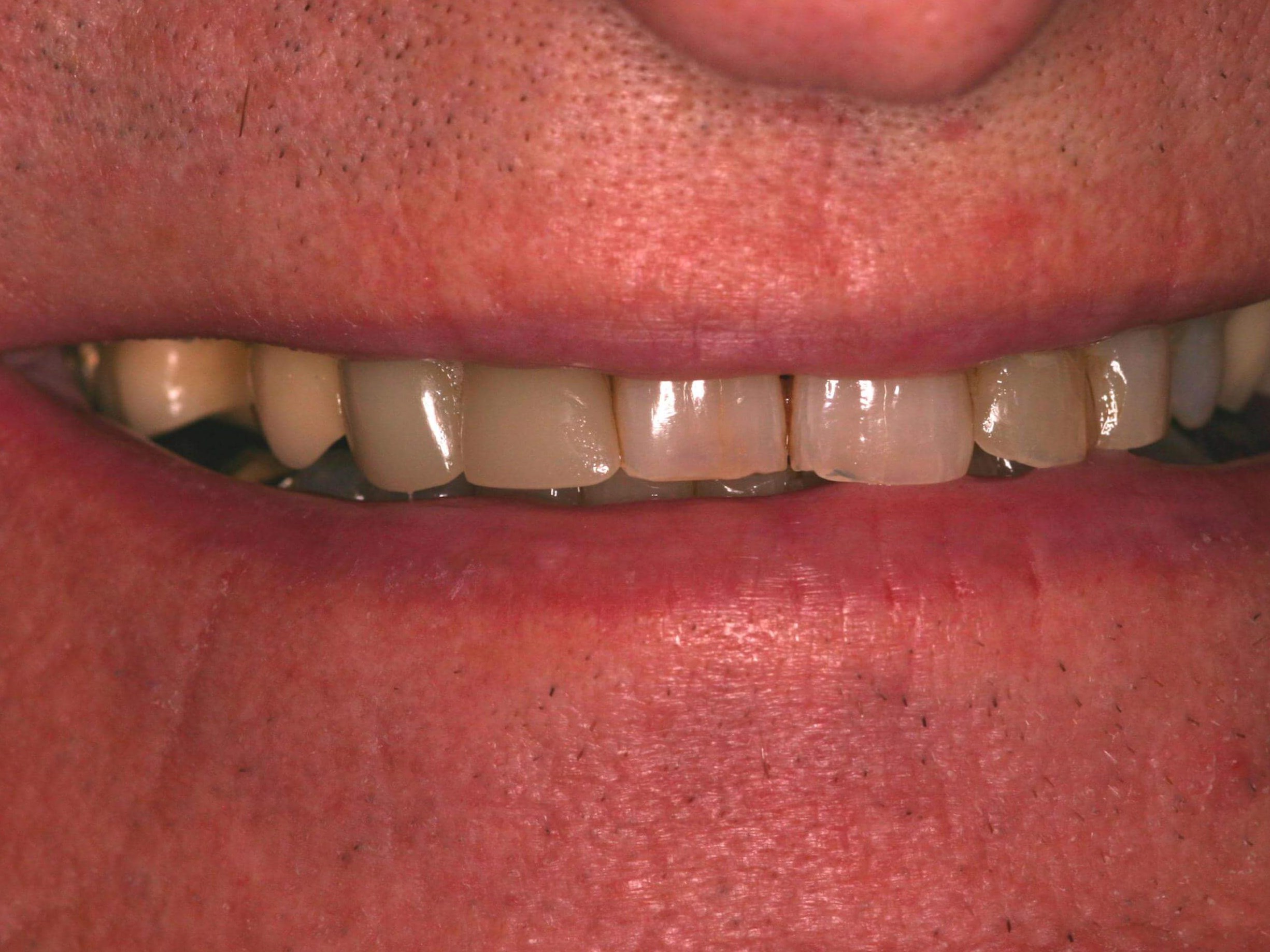 New teeth, new smile! Before