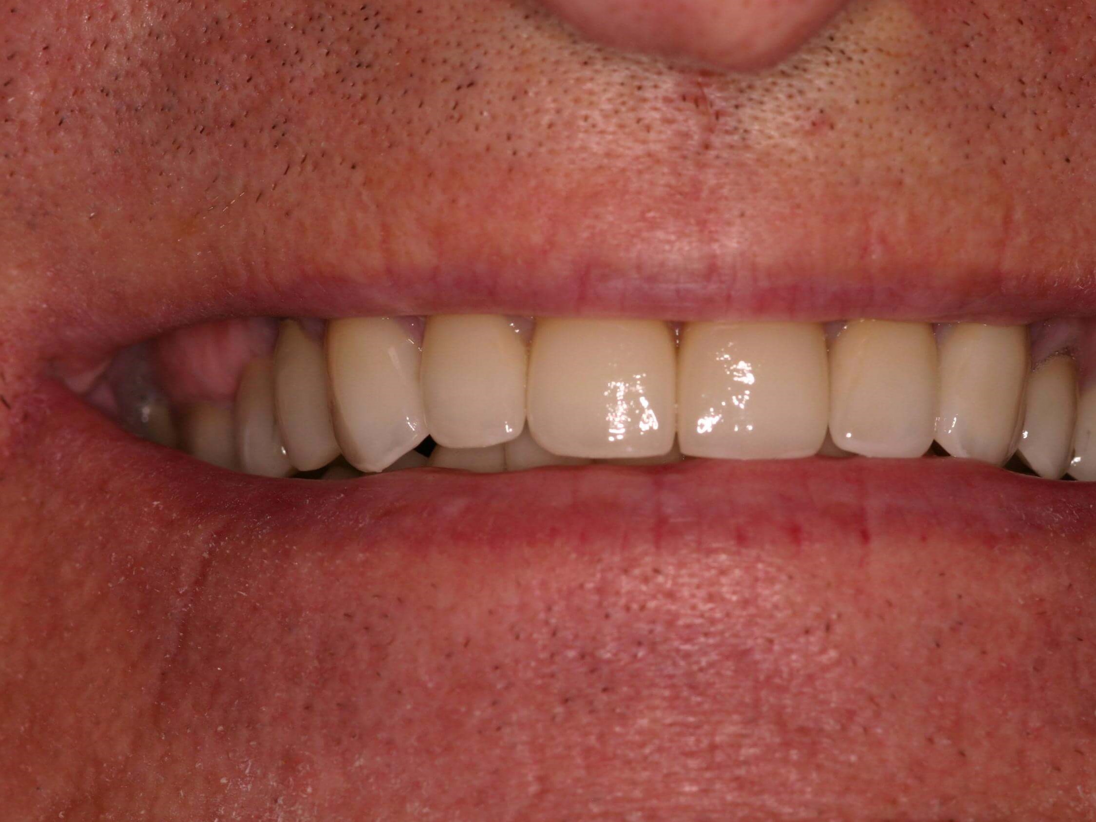 New teeth, new smile! After