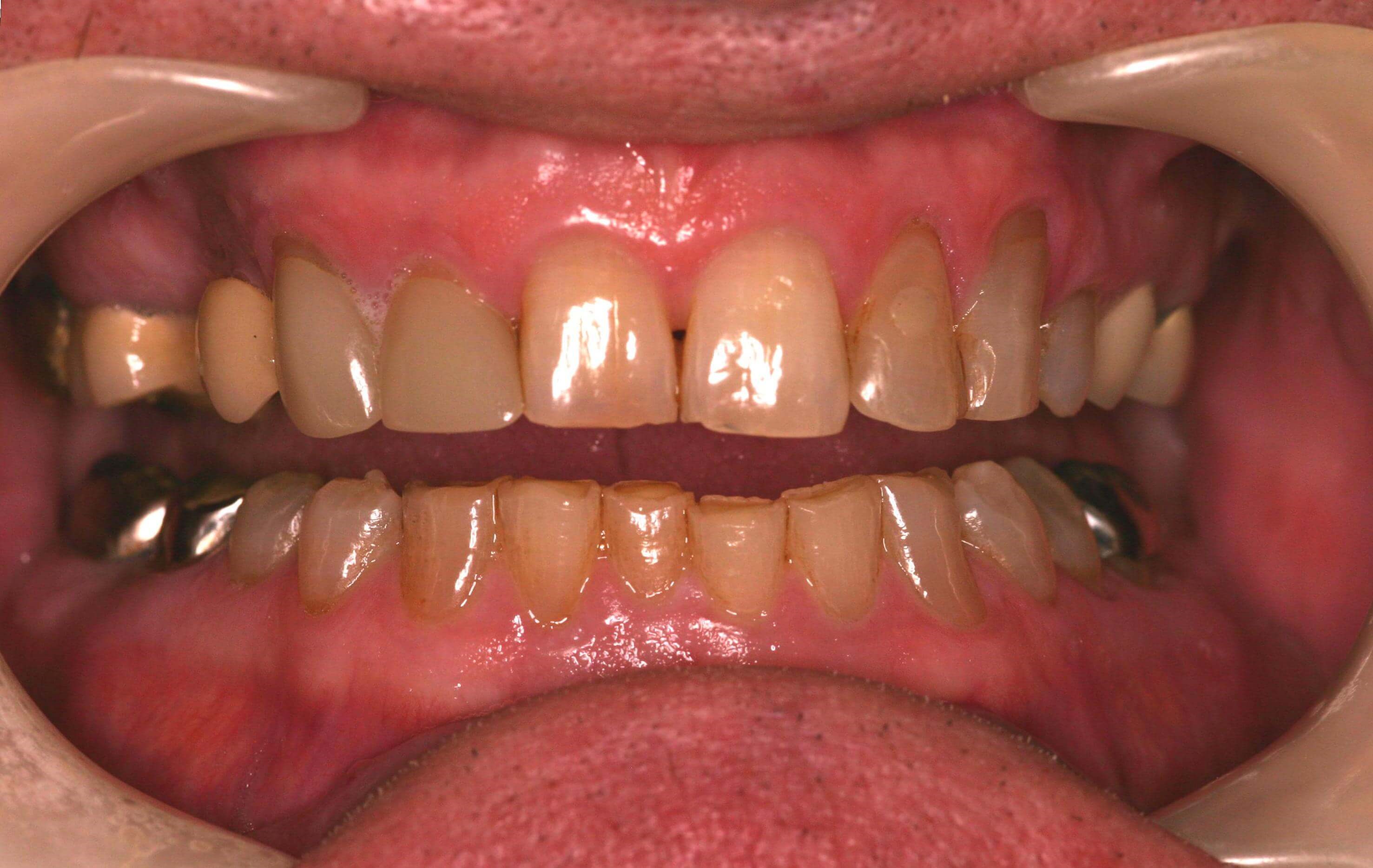 New teeth, new smile! Before