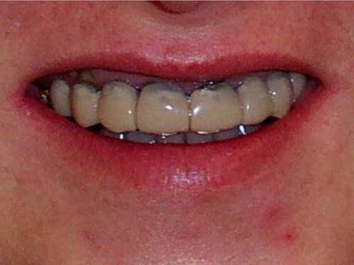 Smile Makeover Before