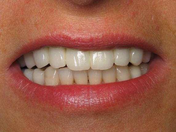 Smile Makeover After