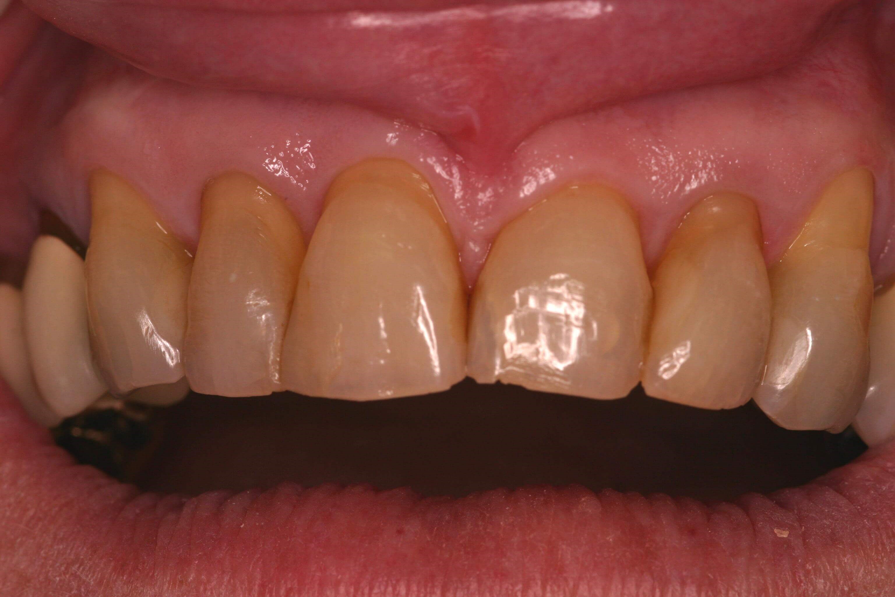 Worn Teeth get a New Smile Before