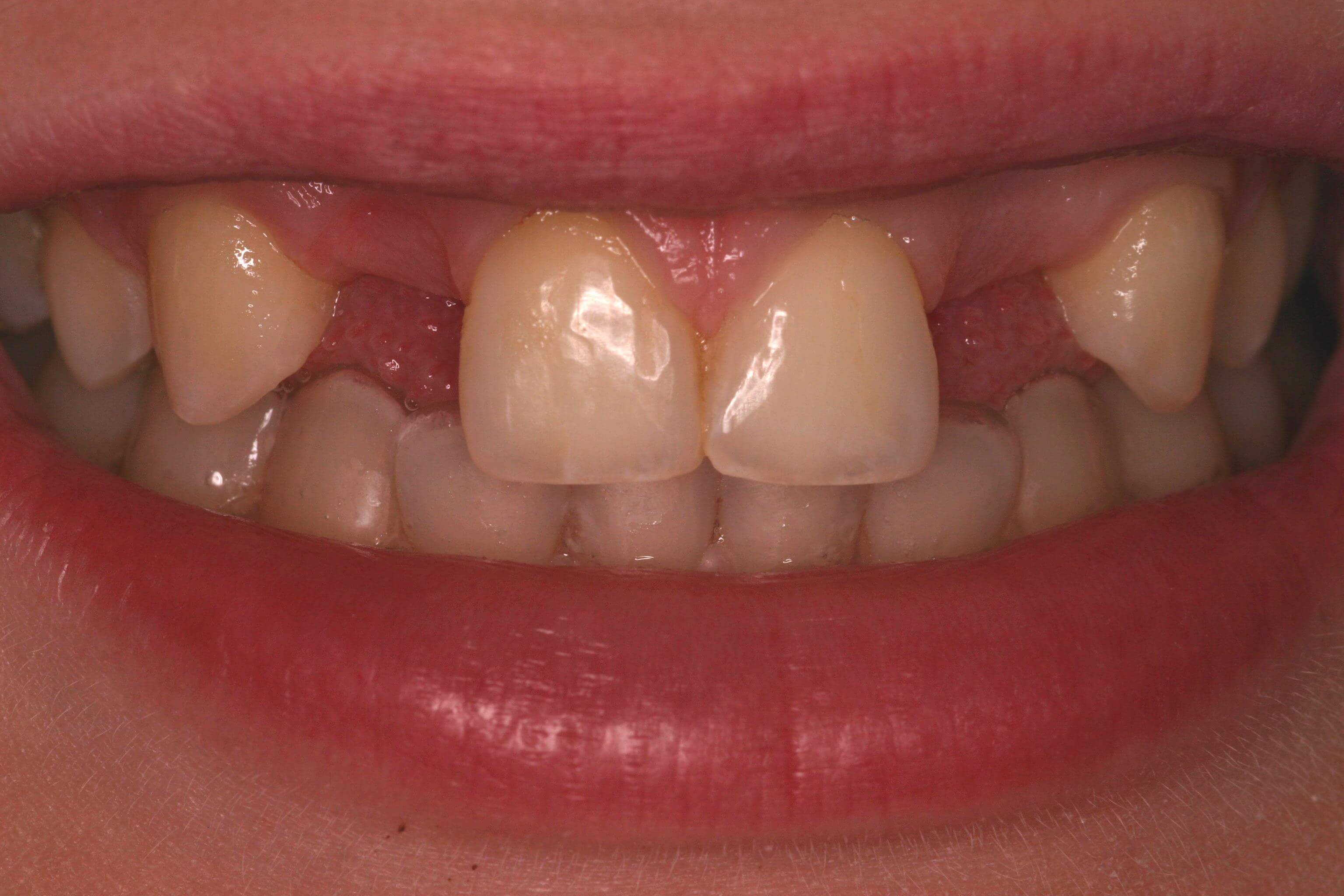 Bonded Maryland Bridges Before