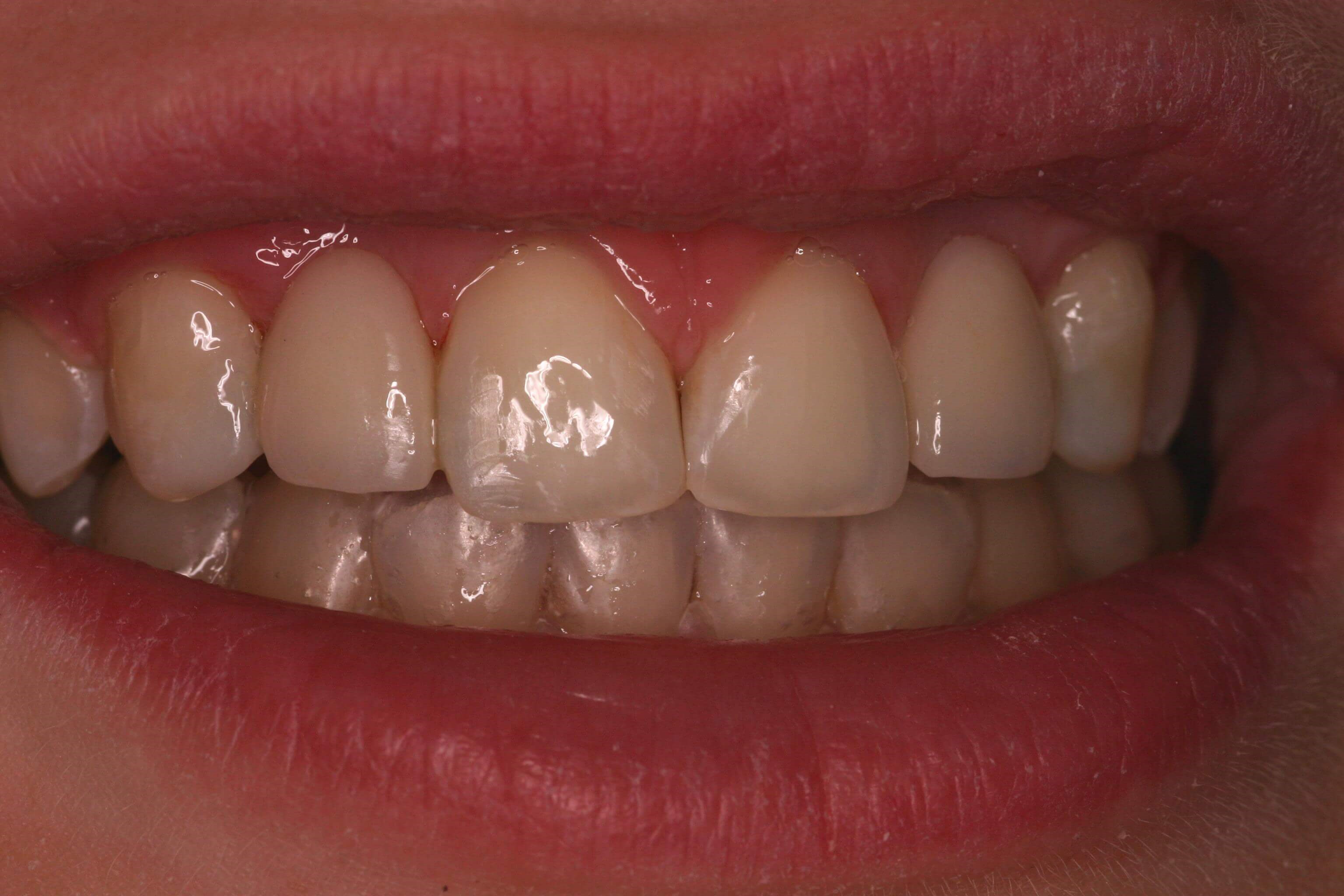 Bonded Maryland Bridges After