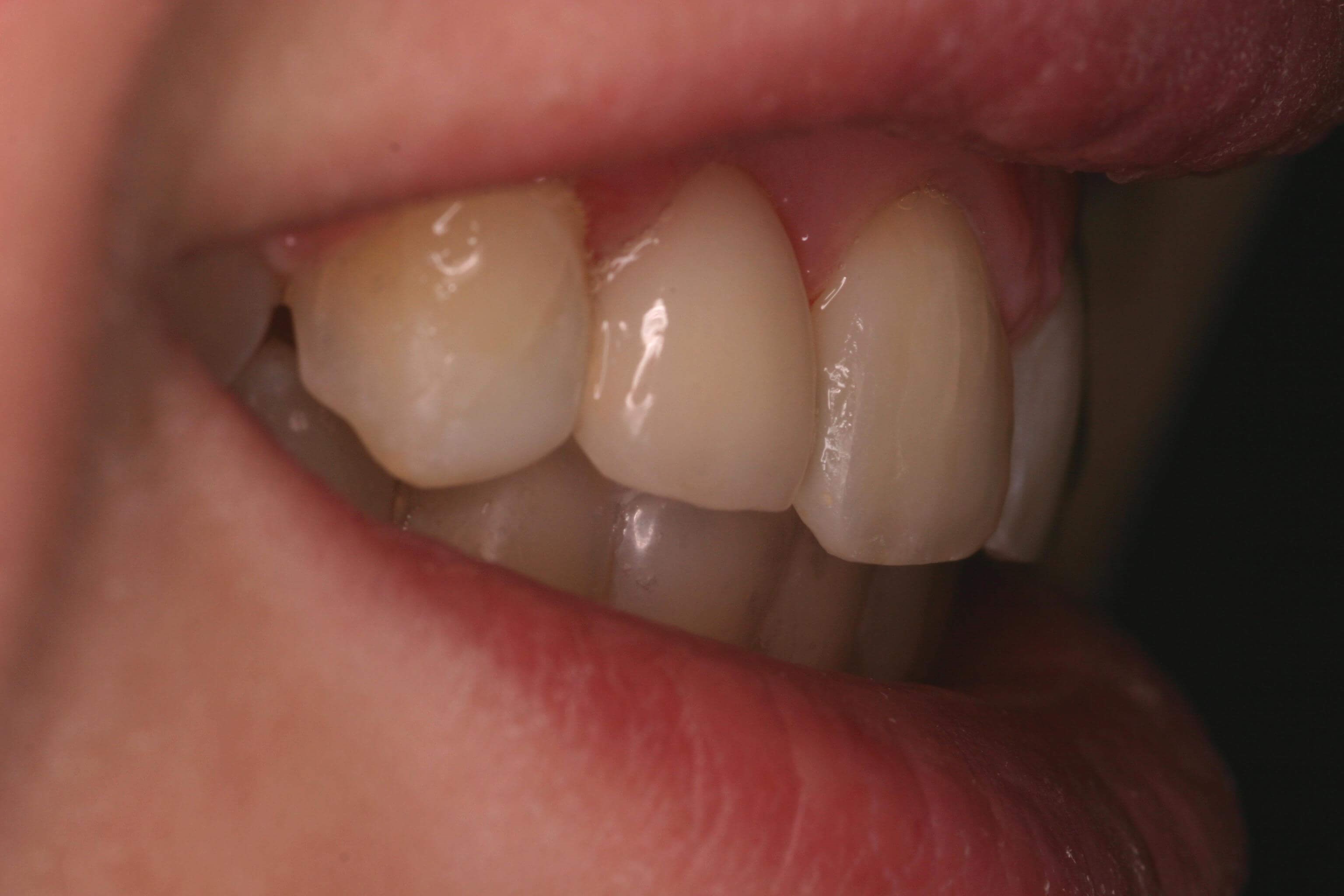 Right Side View After