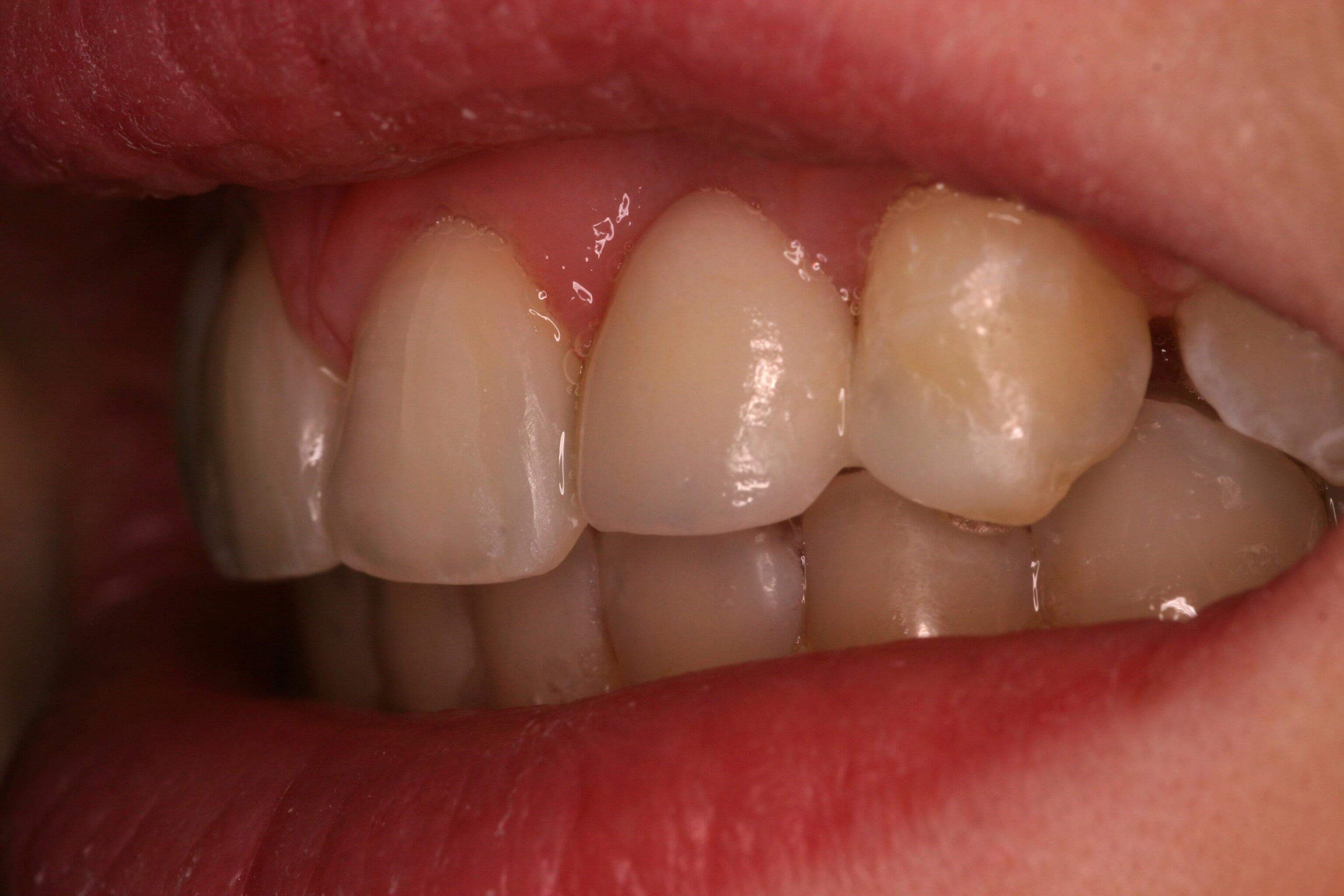 Left side view After