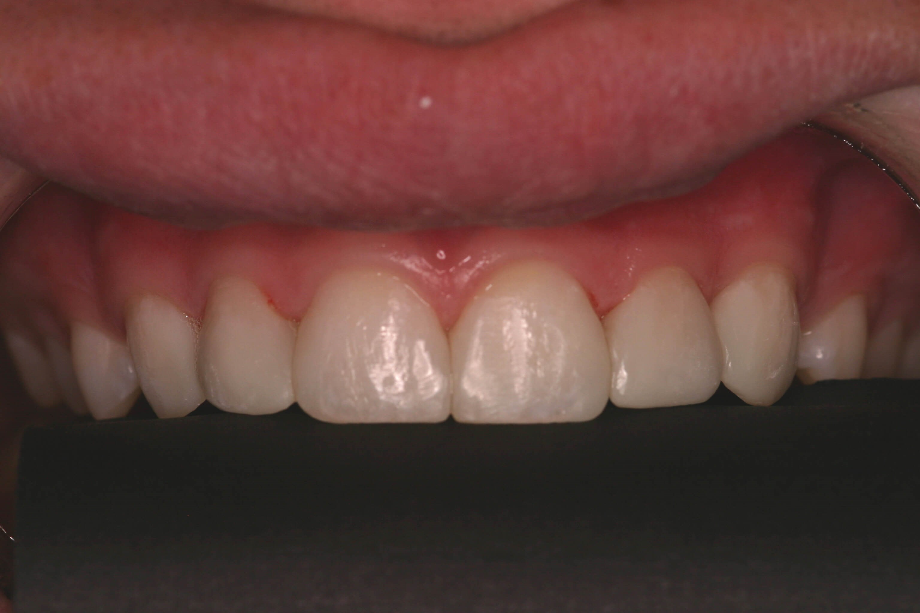 Bonding Before and After After Close up