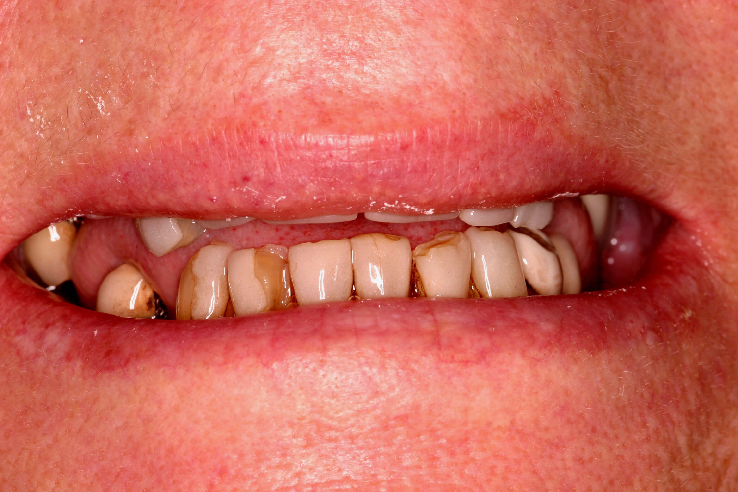 Bonding to eliminate decay Before