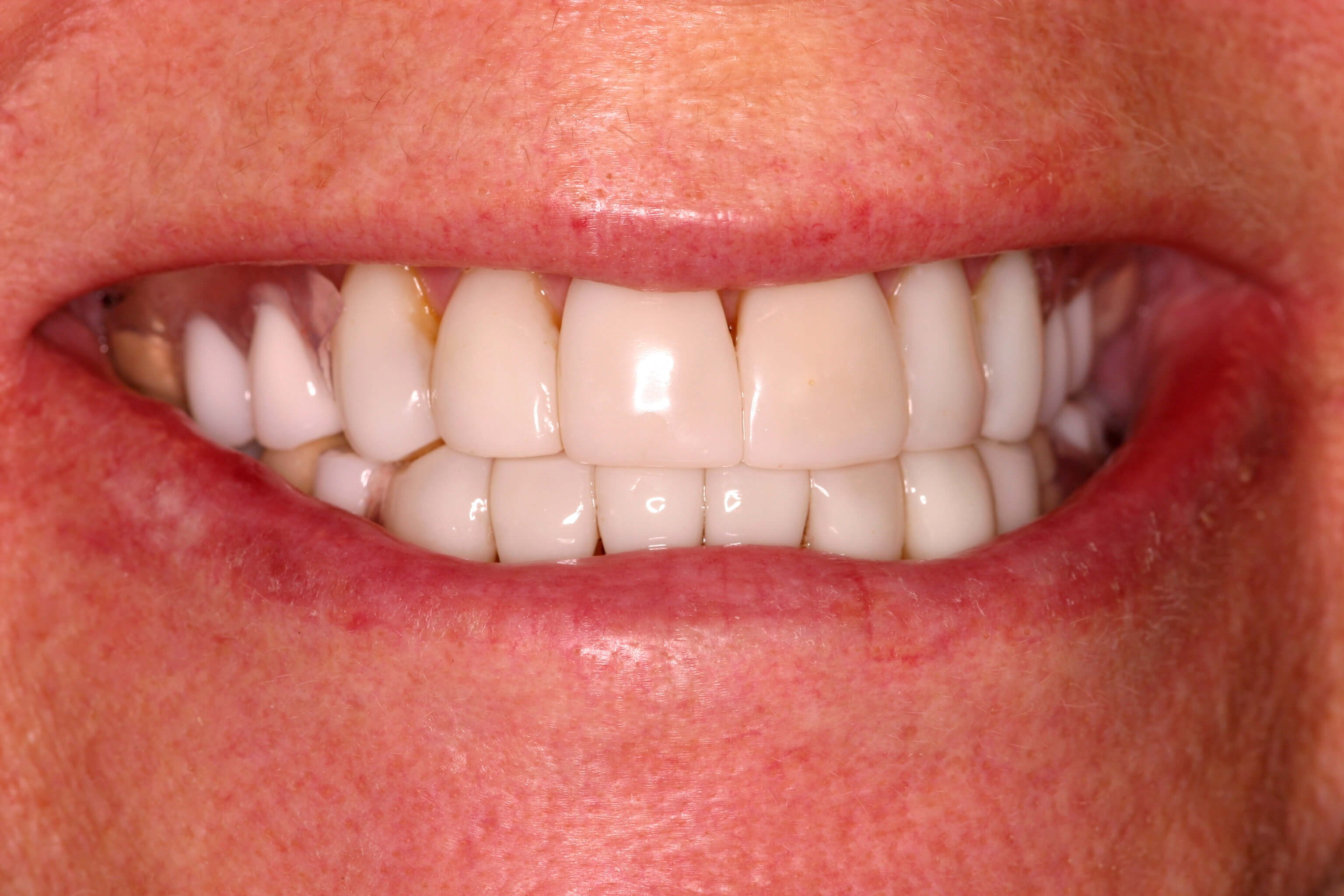 Bonding to eliminate decay After