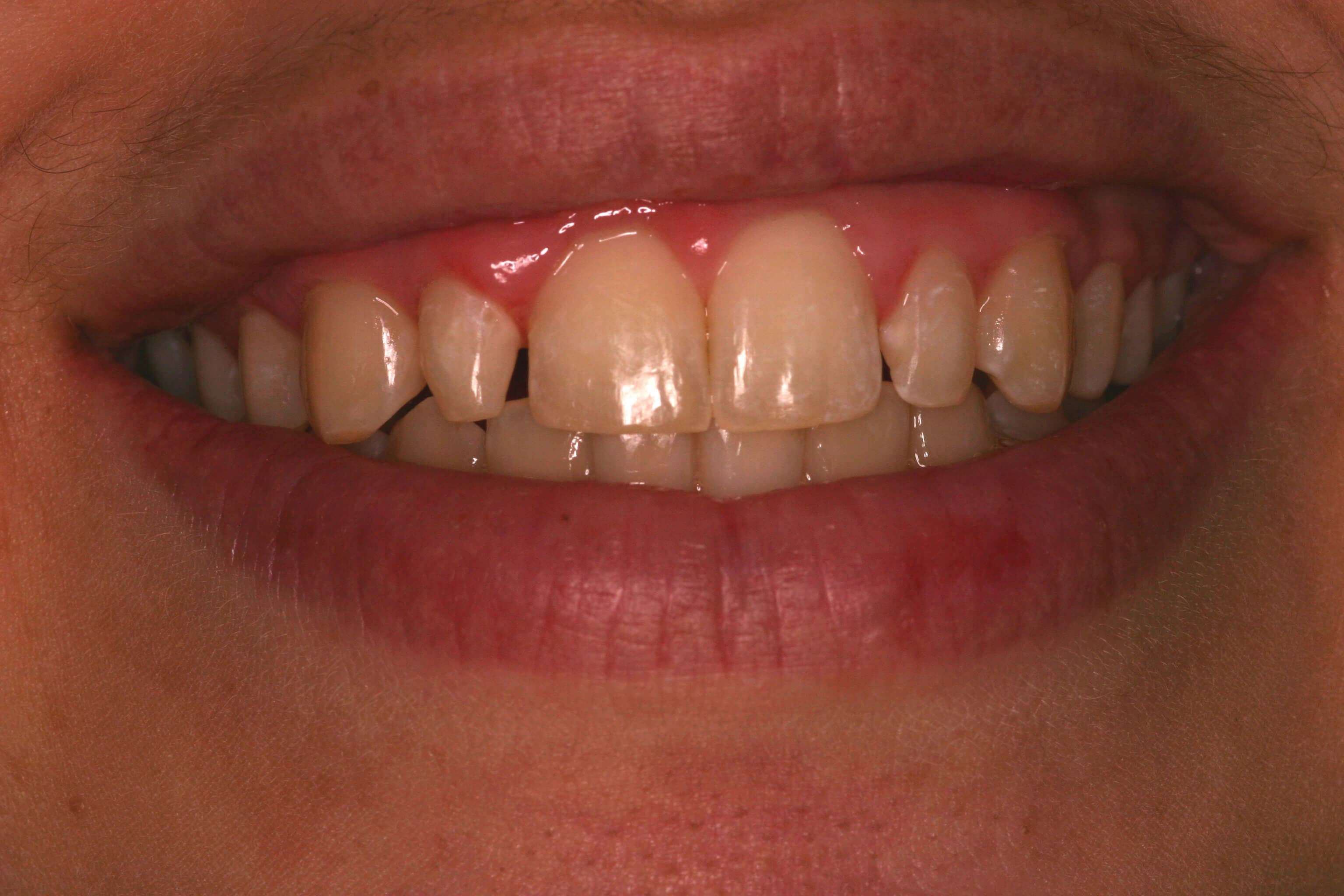 Dental Bonding Smile Makeover Before Bonding