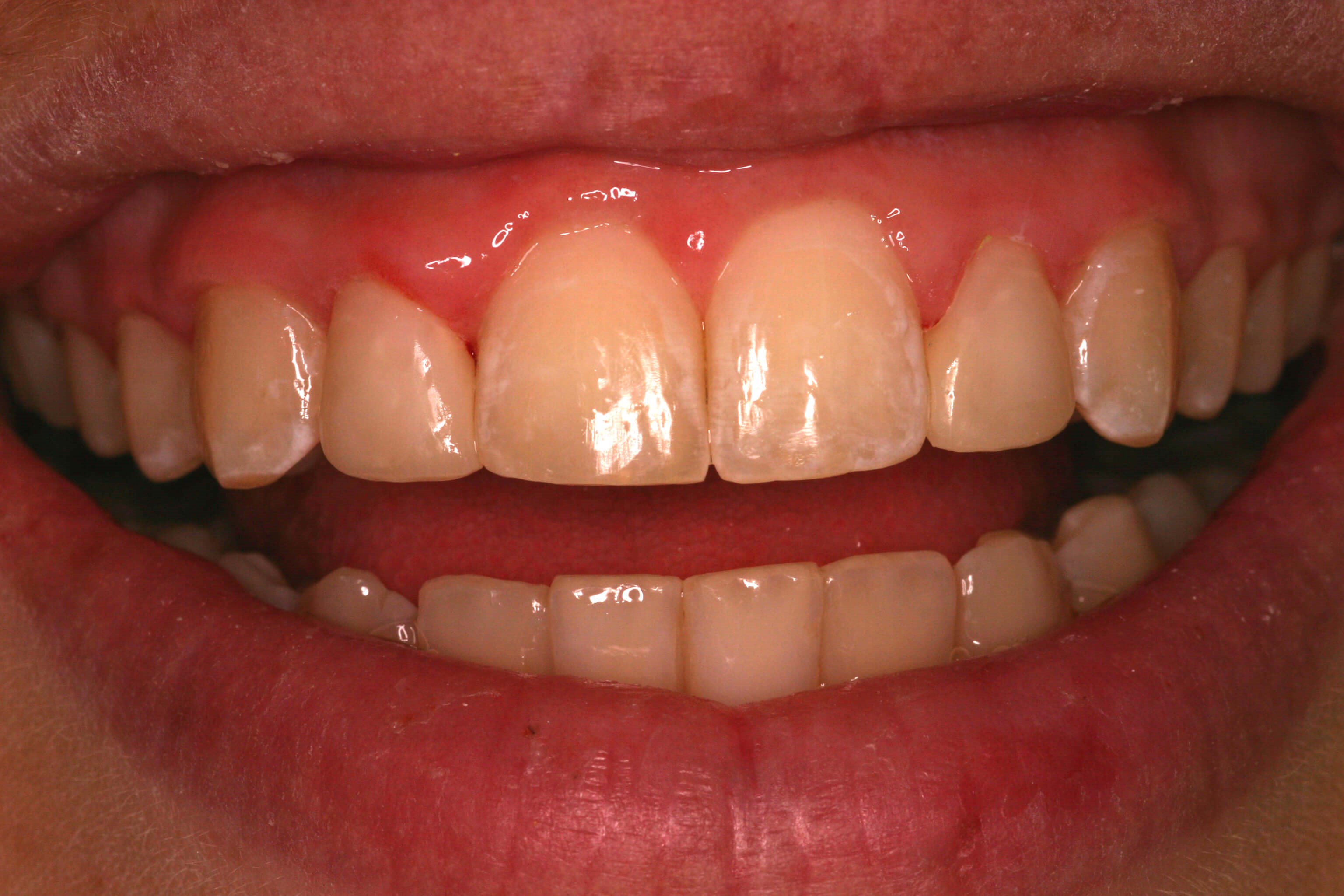 Dental Bonding Smile Makeover After Bonding