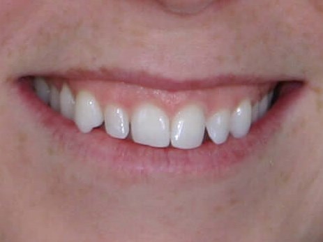 Chairside Smile Makeover Before Bonding