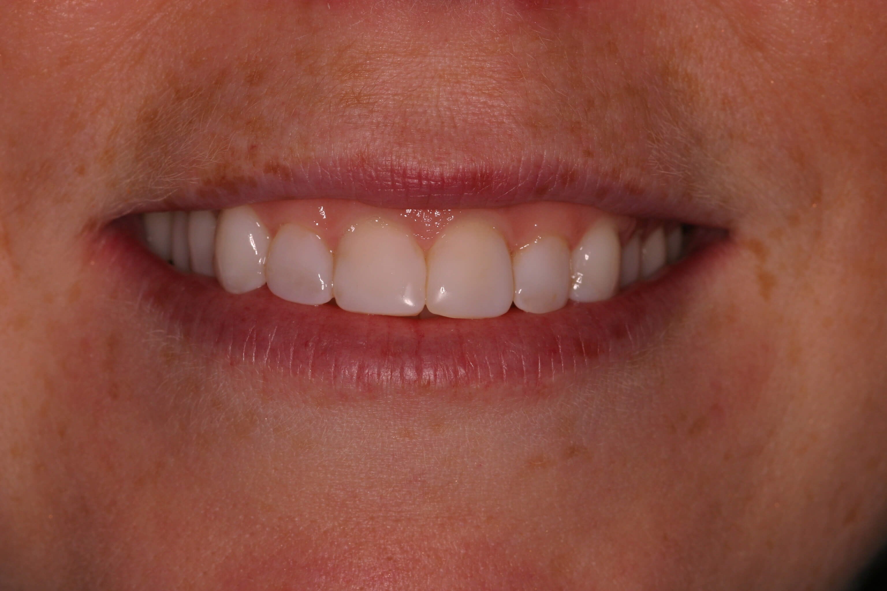 Chairside Smile Makeover After Bonding