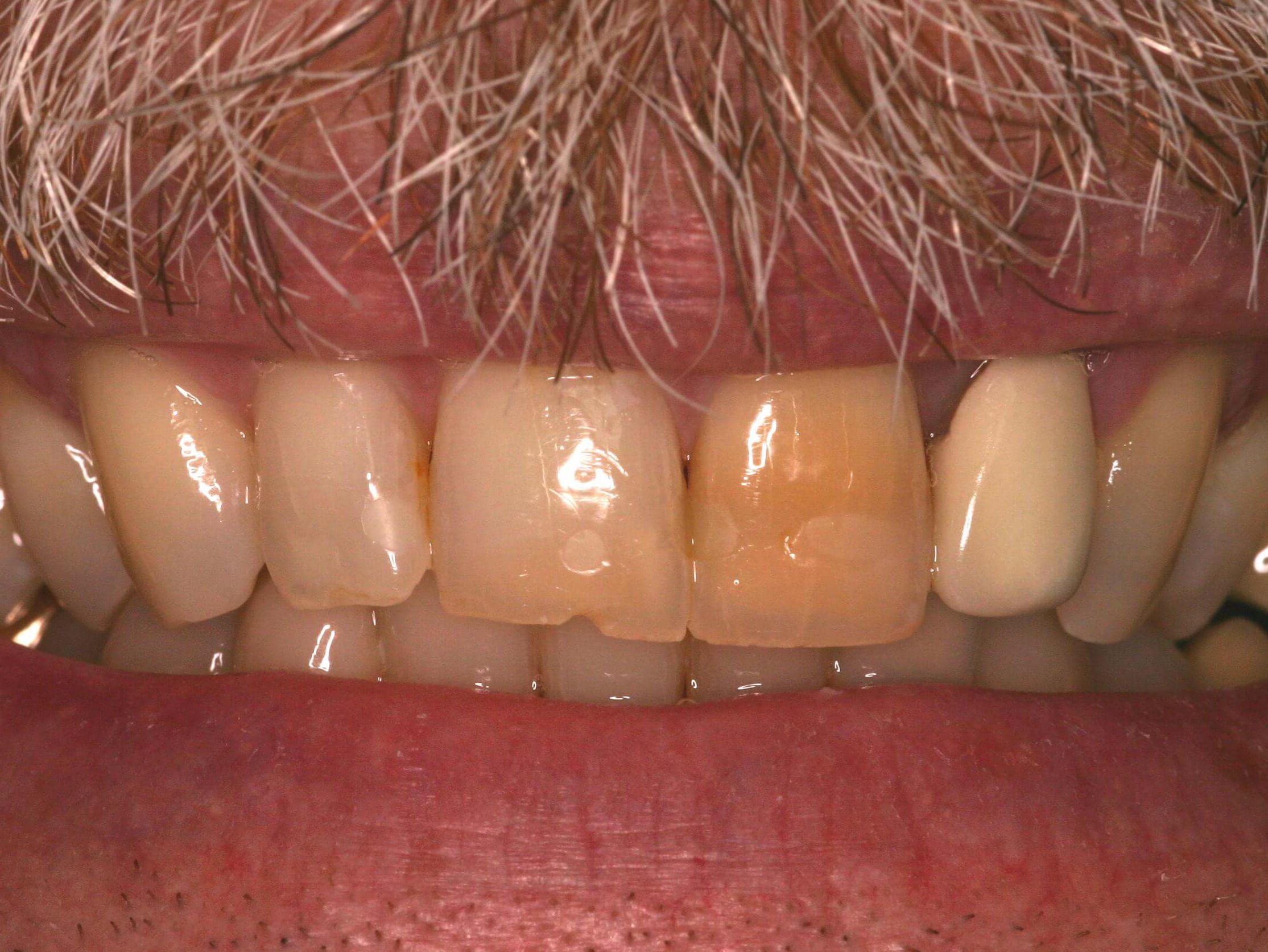 CEREC One Day Crowns Before