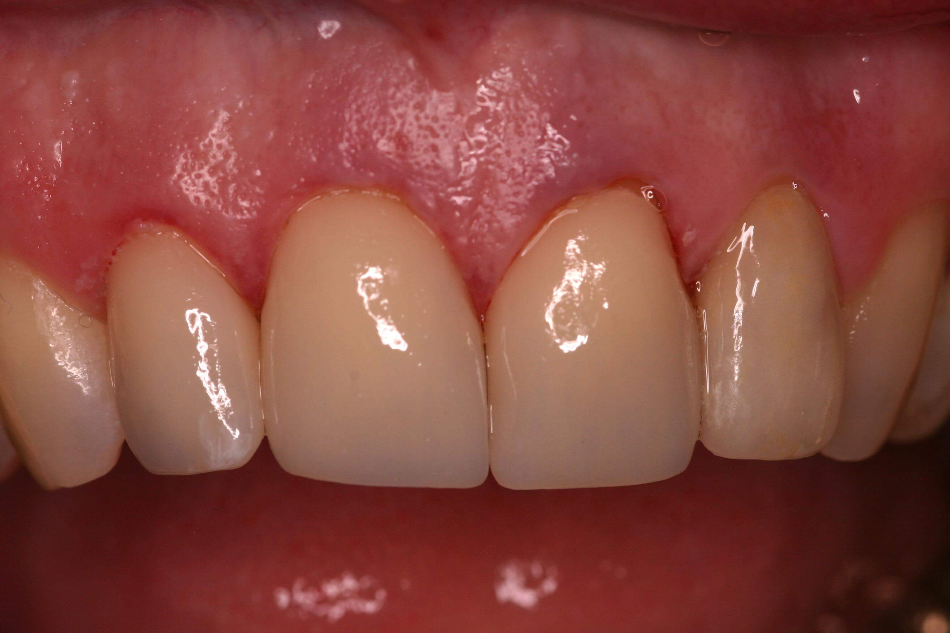 CEREC One Day Crowns After