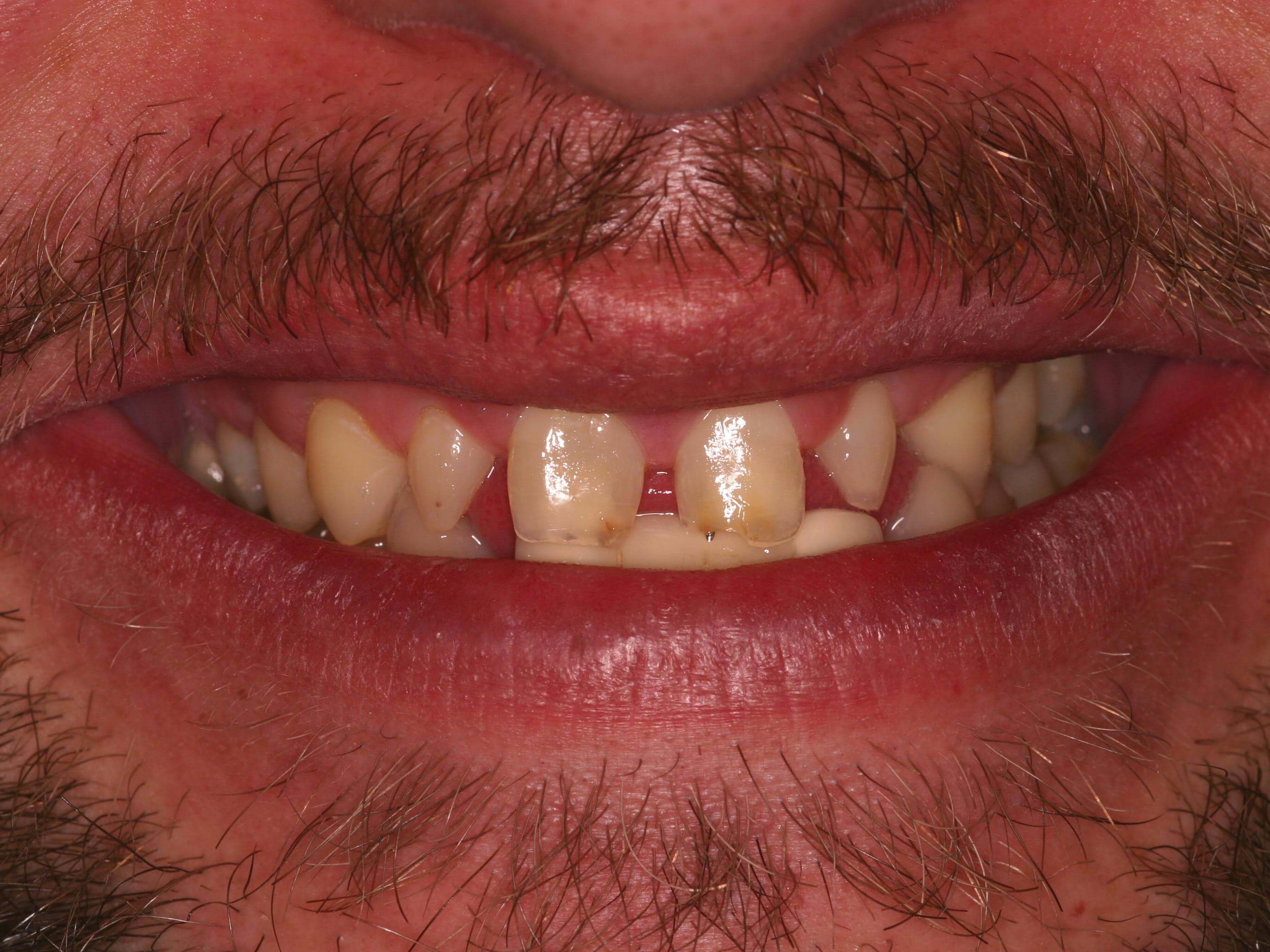 Young Man Wants a new Smile Before