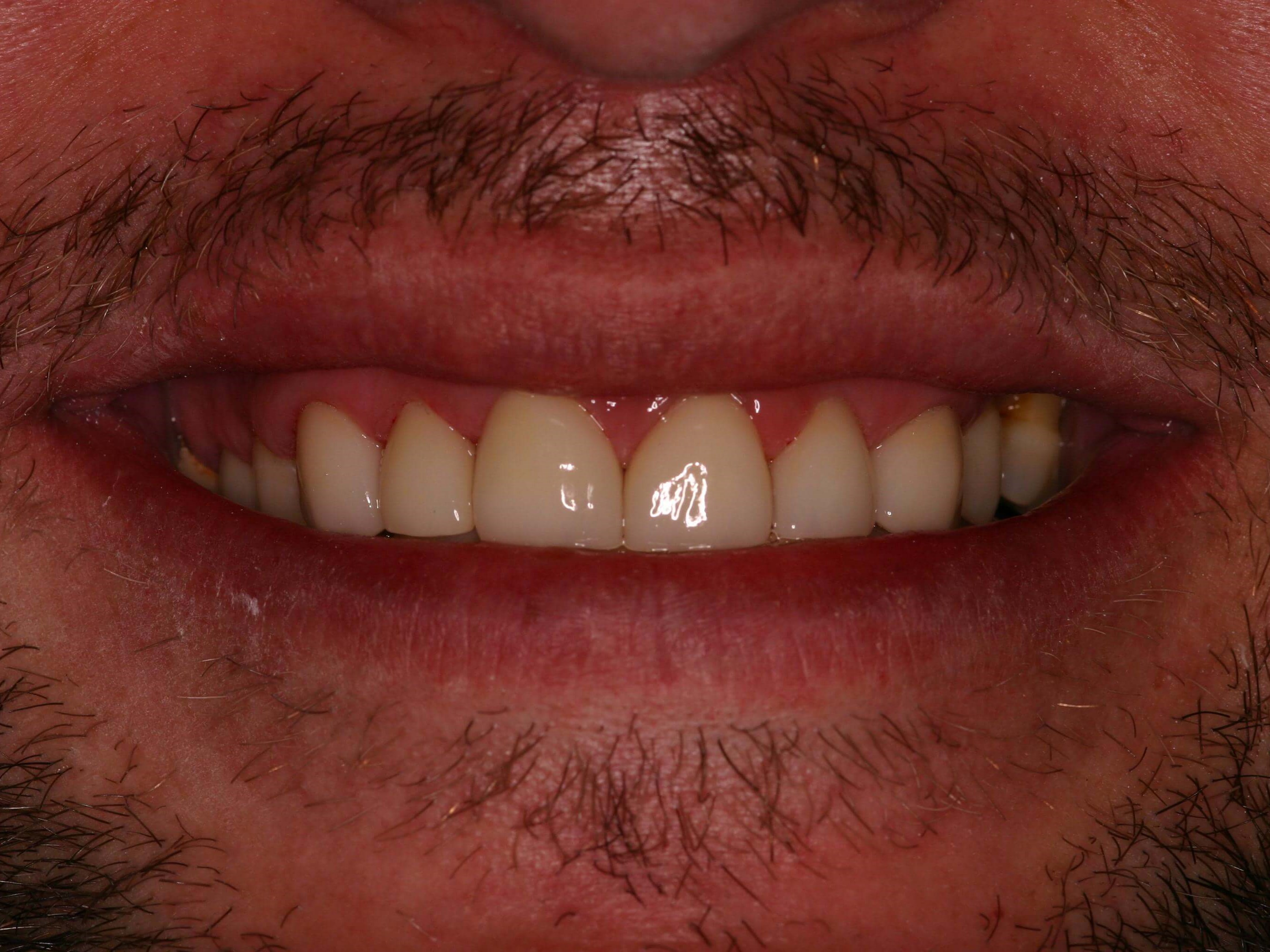 Young Man Wants a new Smile After