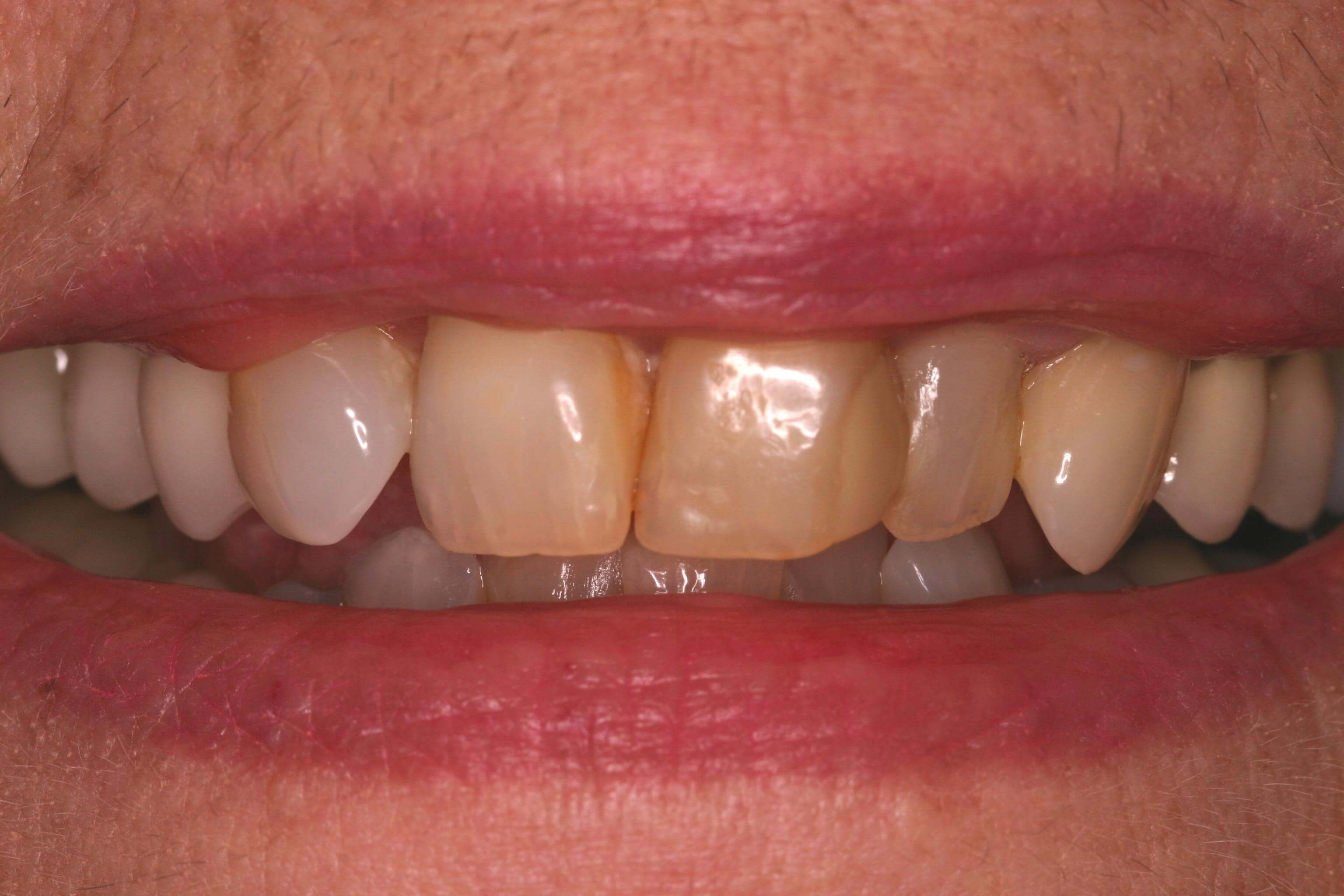 New Smile Wanted Before