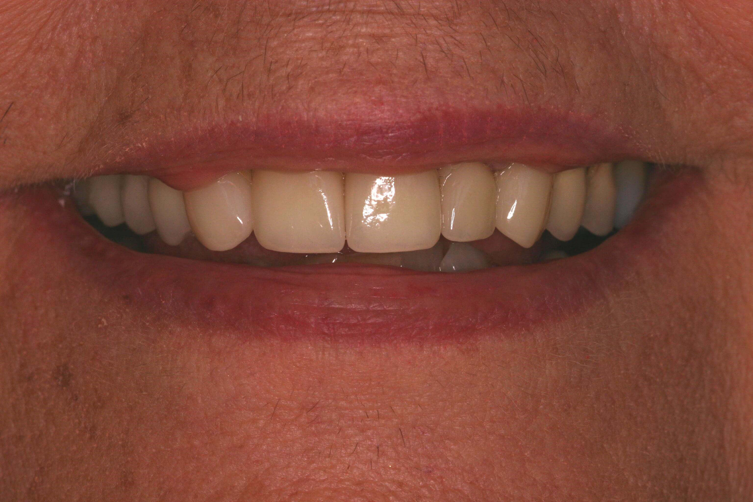 New Smile Wanted After