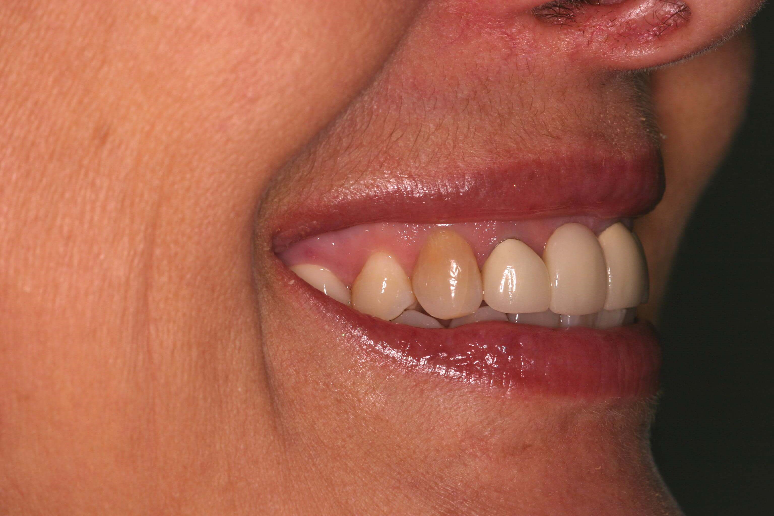 Patient Right Side Before