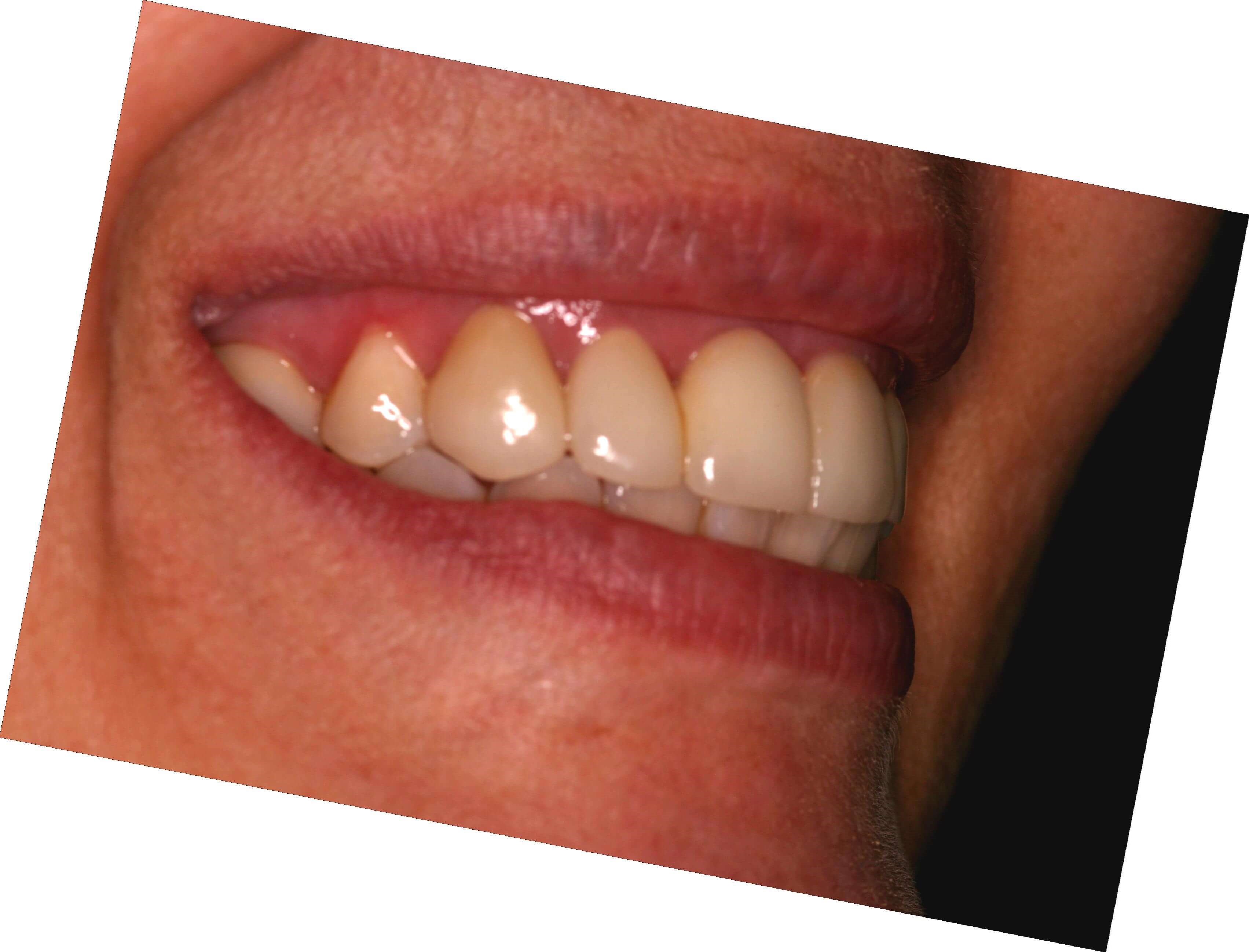 Patient Right Side After