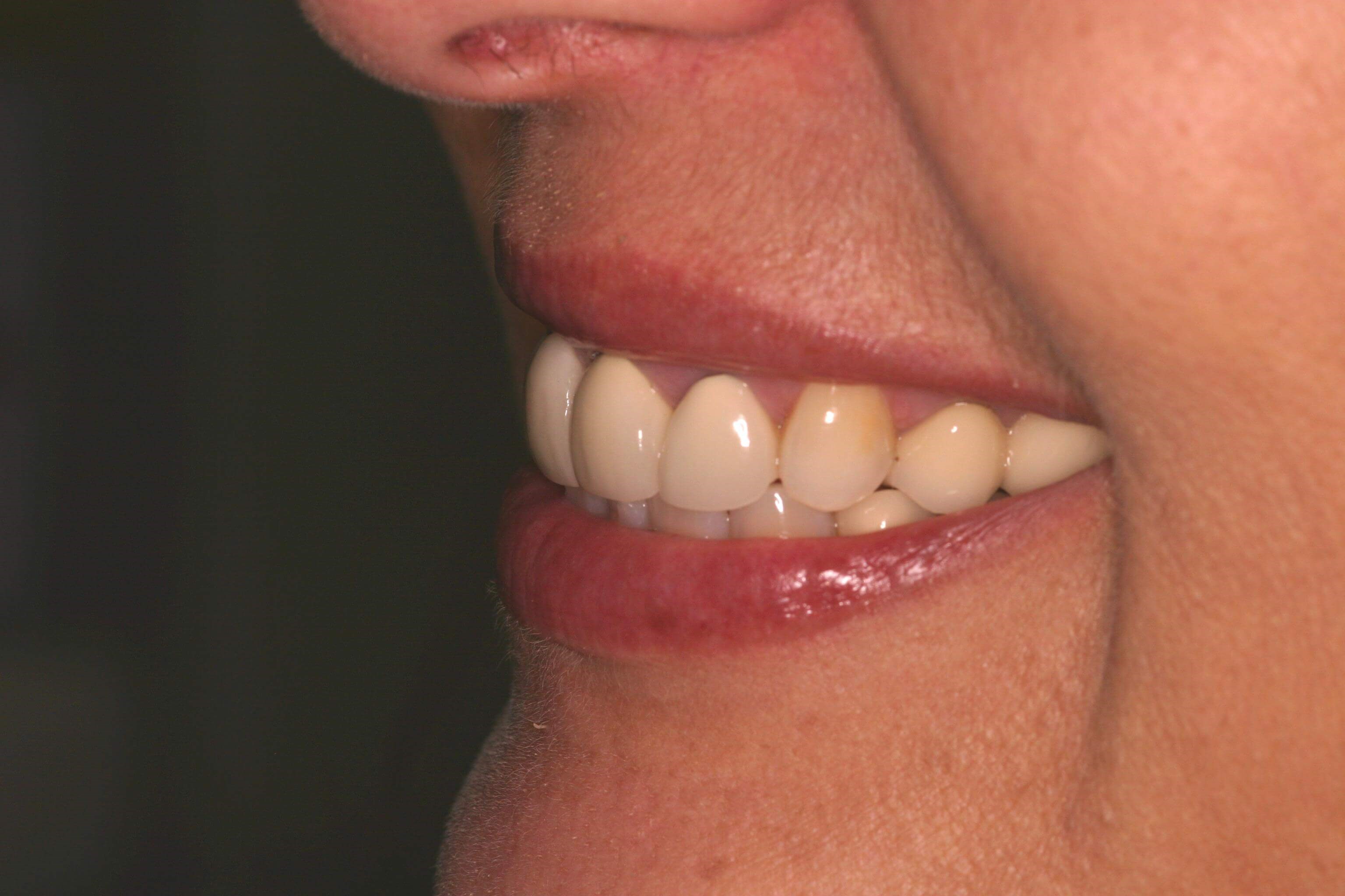 Patient Left Side Before