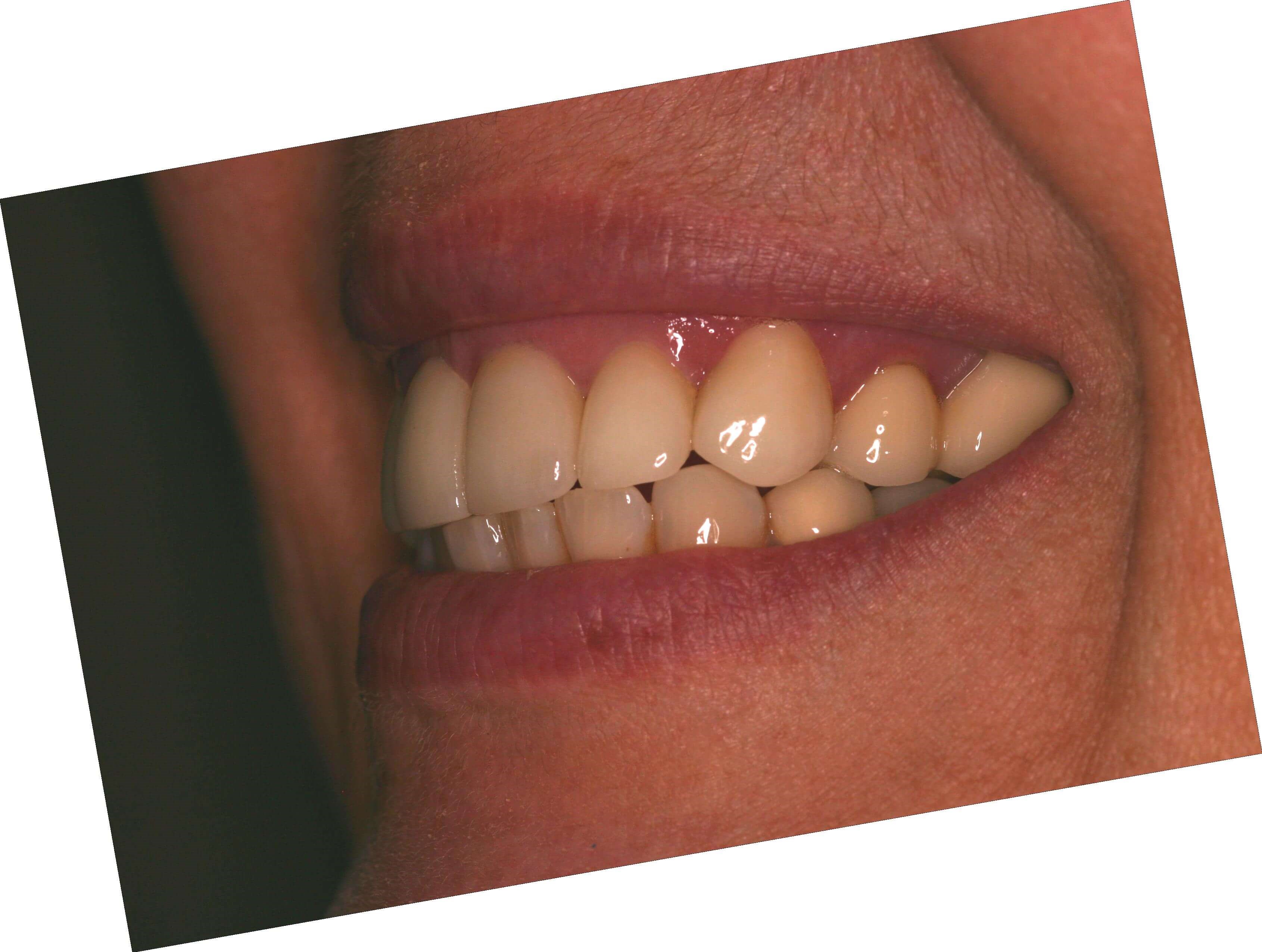 Patient Left Side After