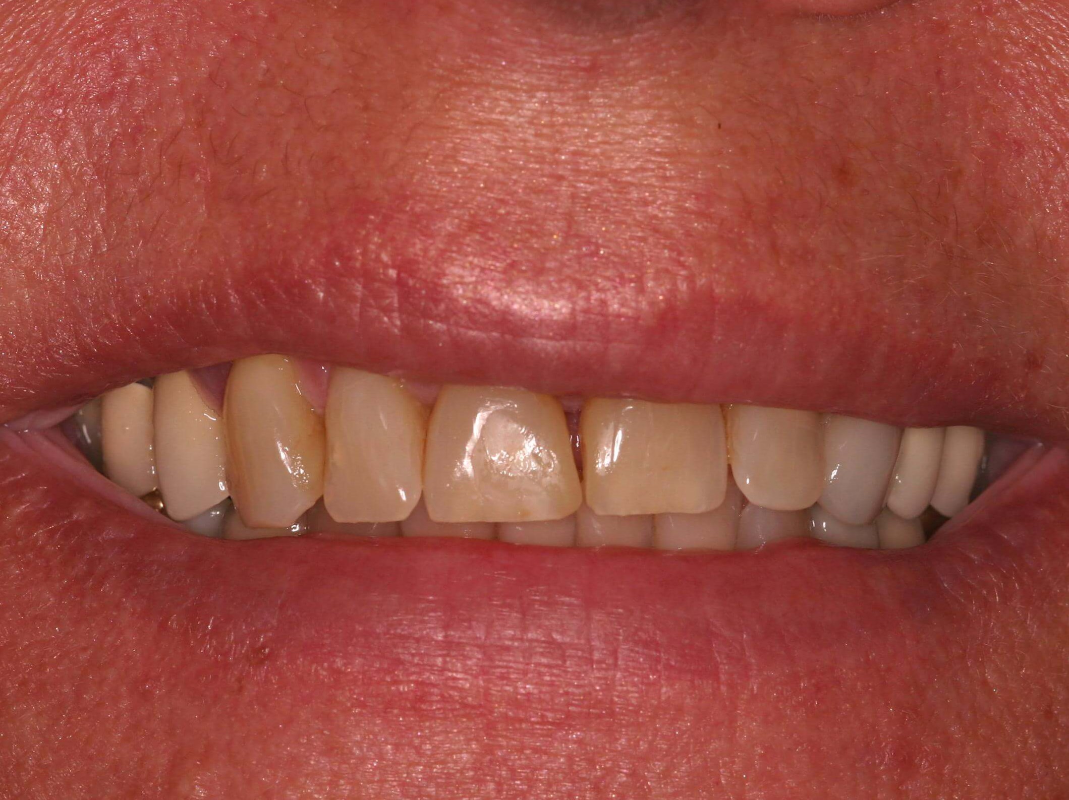 Smile Makeover Before