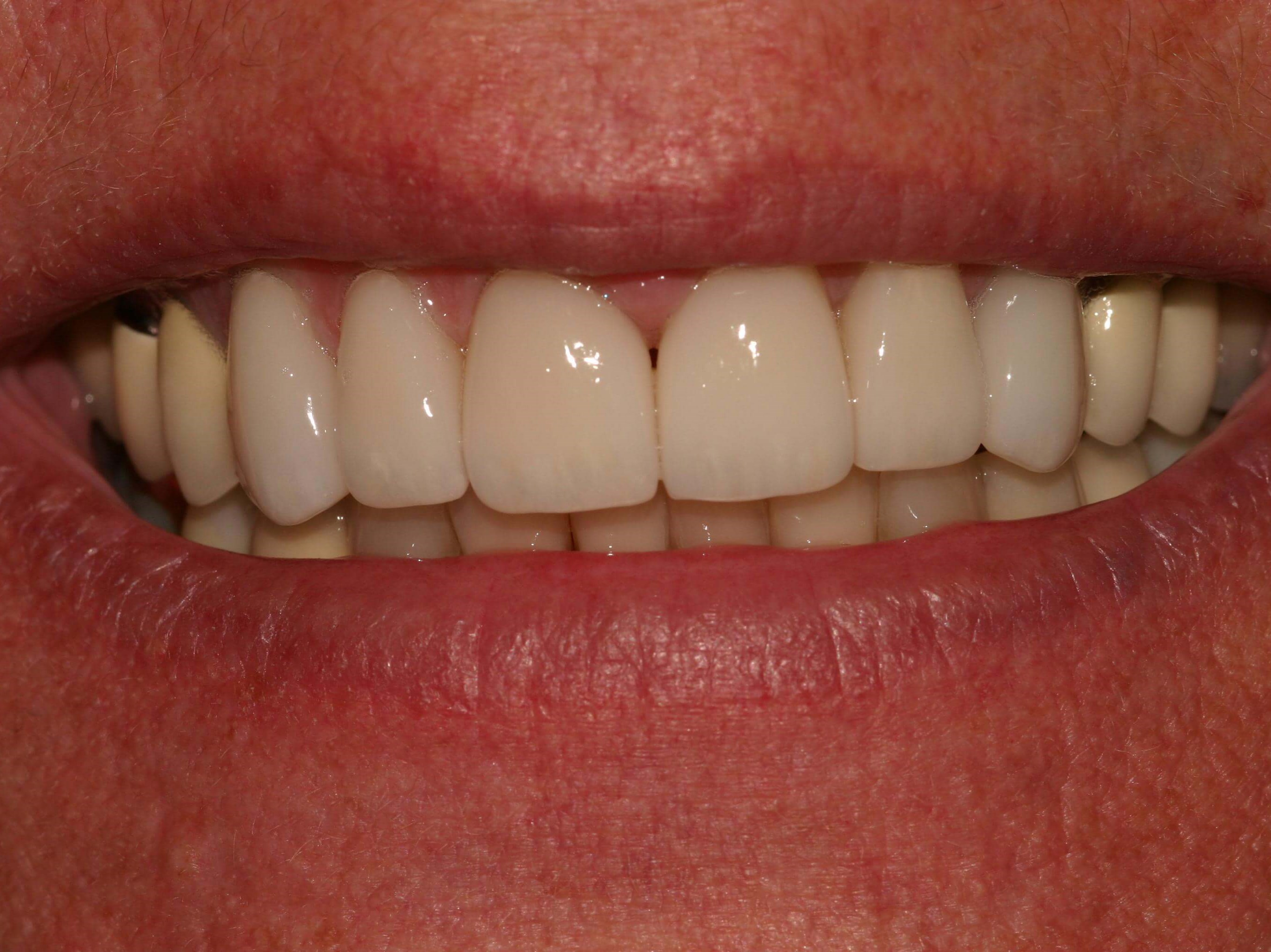 Smile Makeover After
