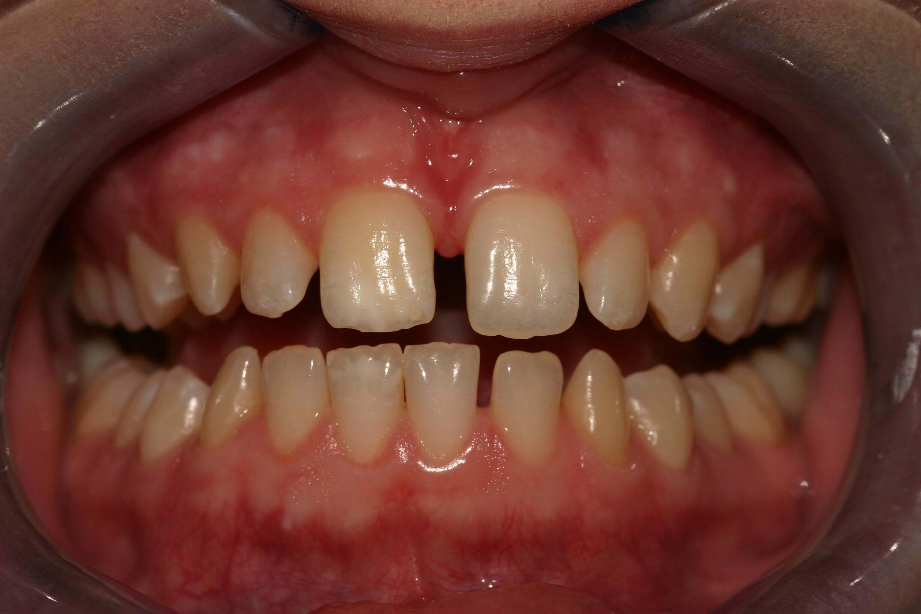 Retracted View Before