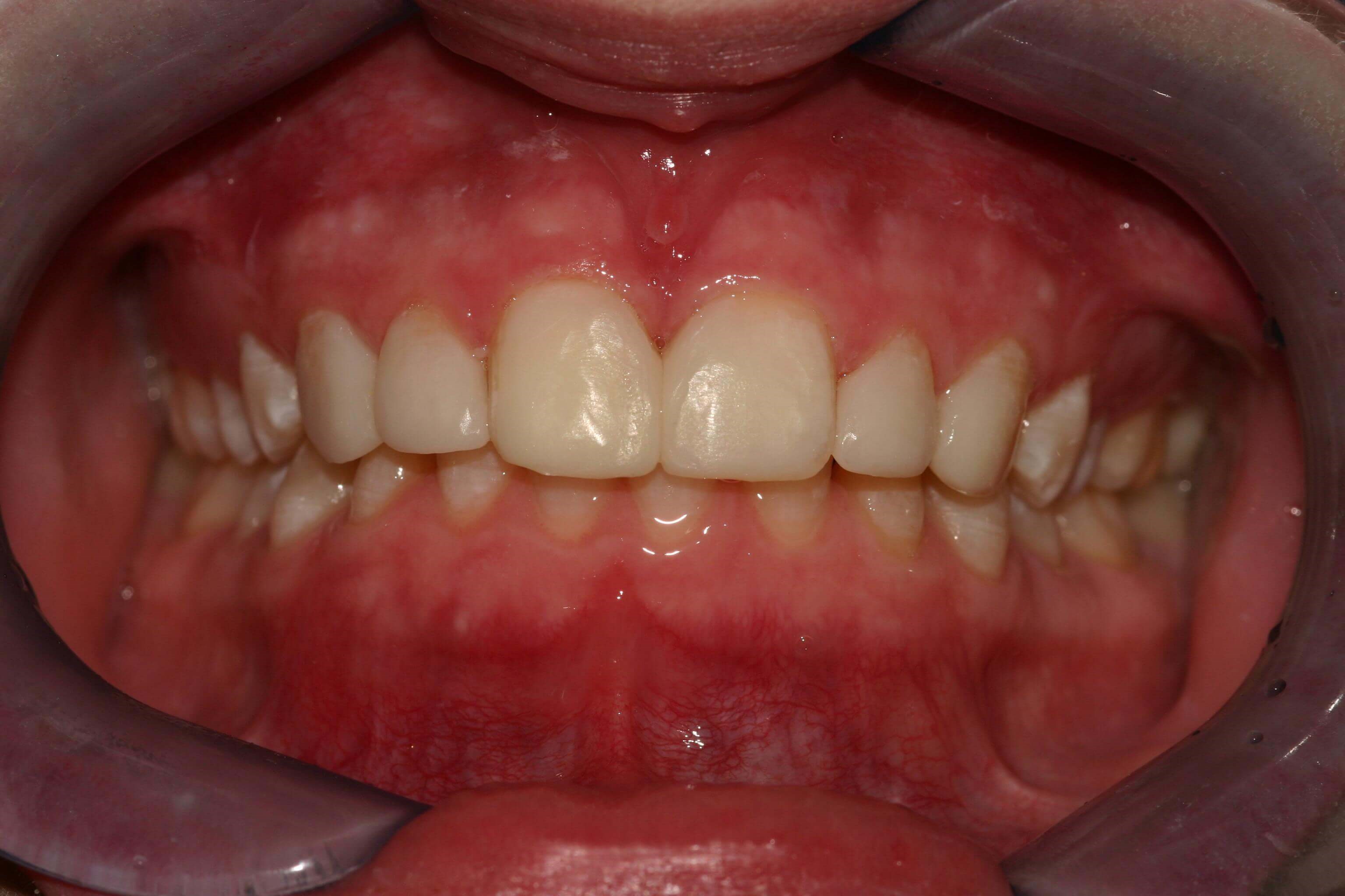 Retracted View After