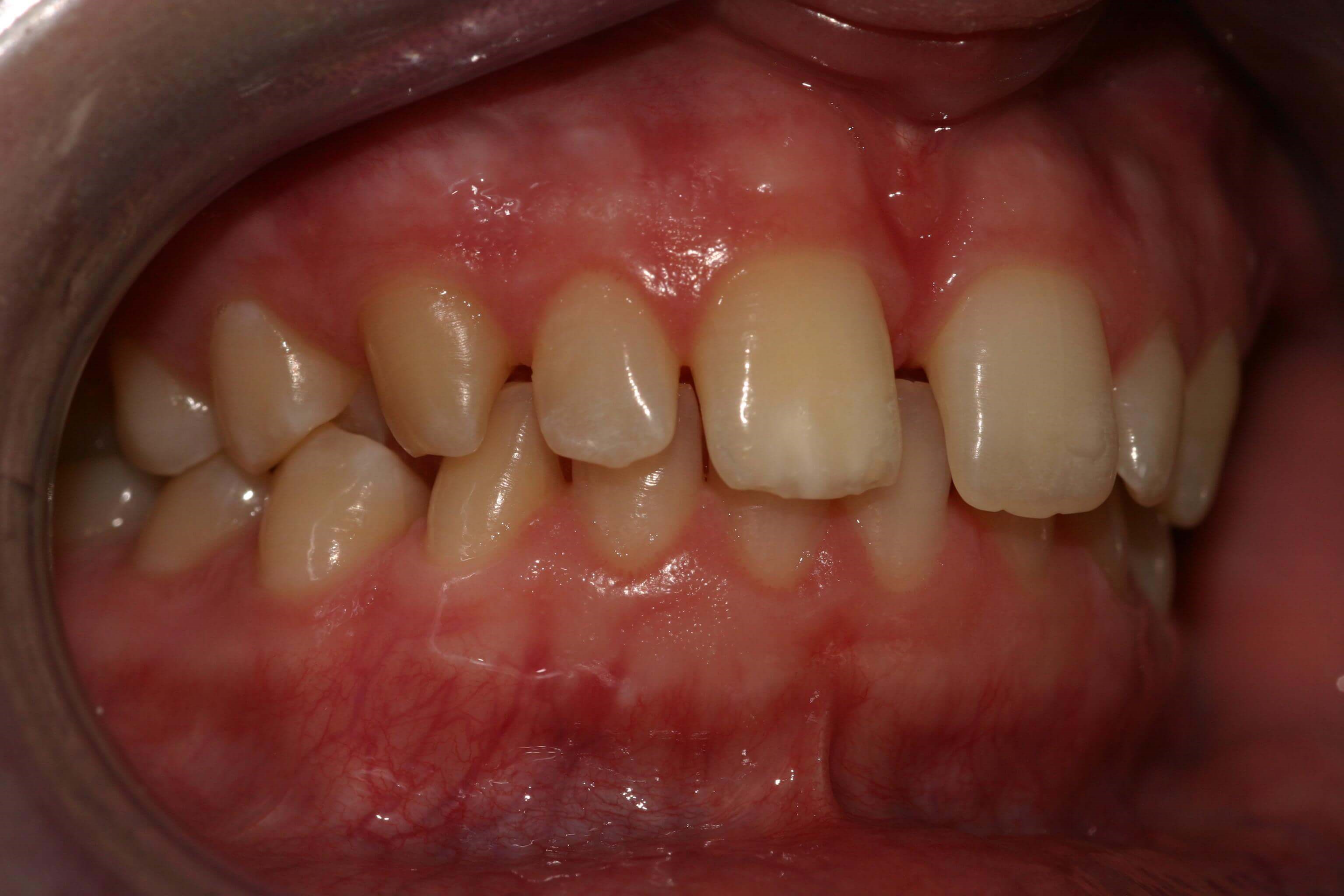 Retracted Right View Before