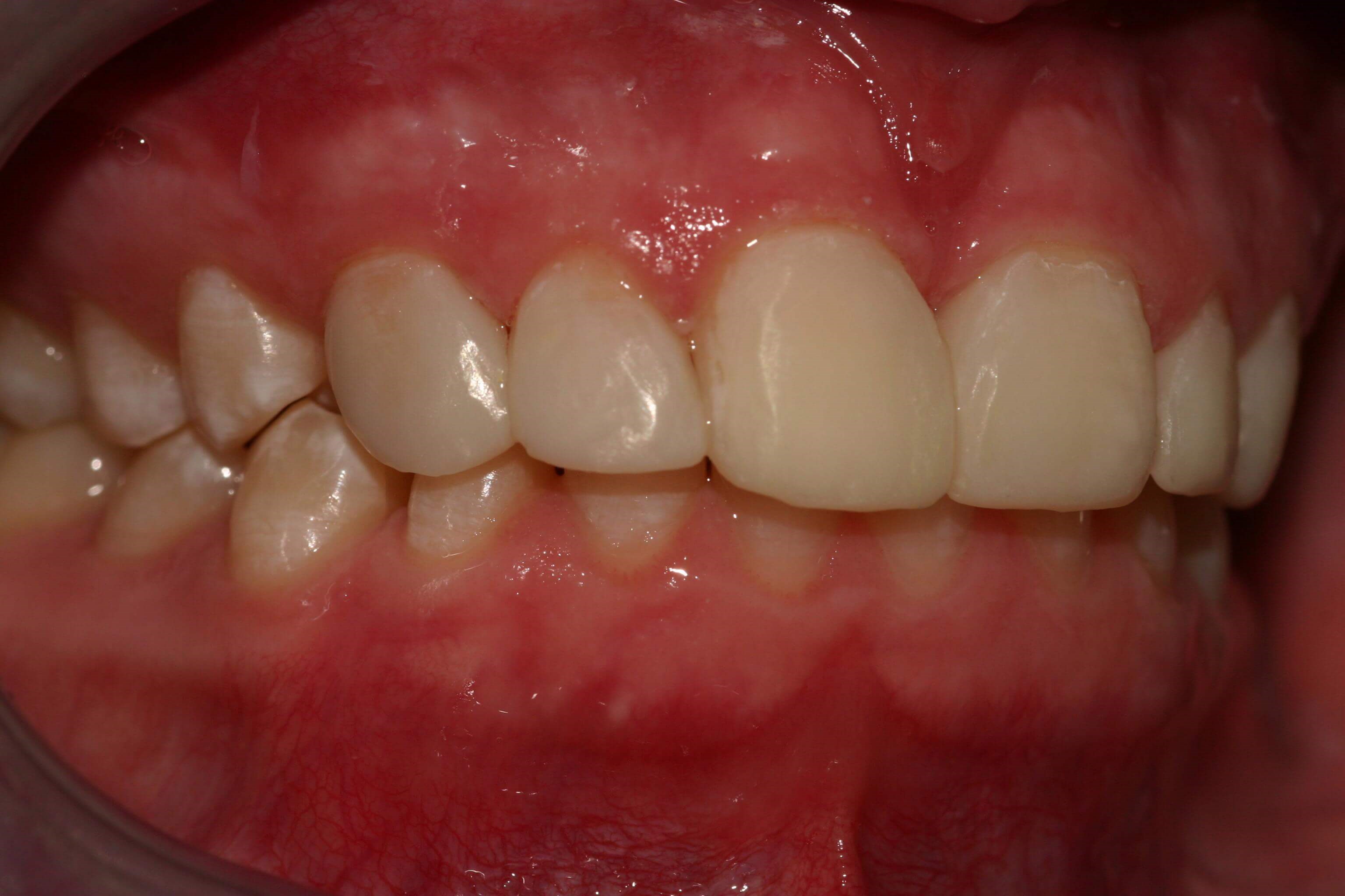 Retracted Right View After