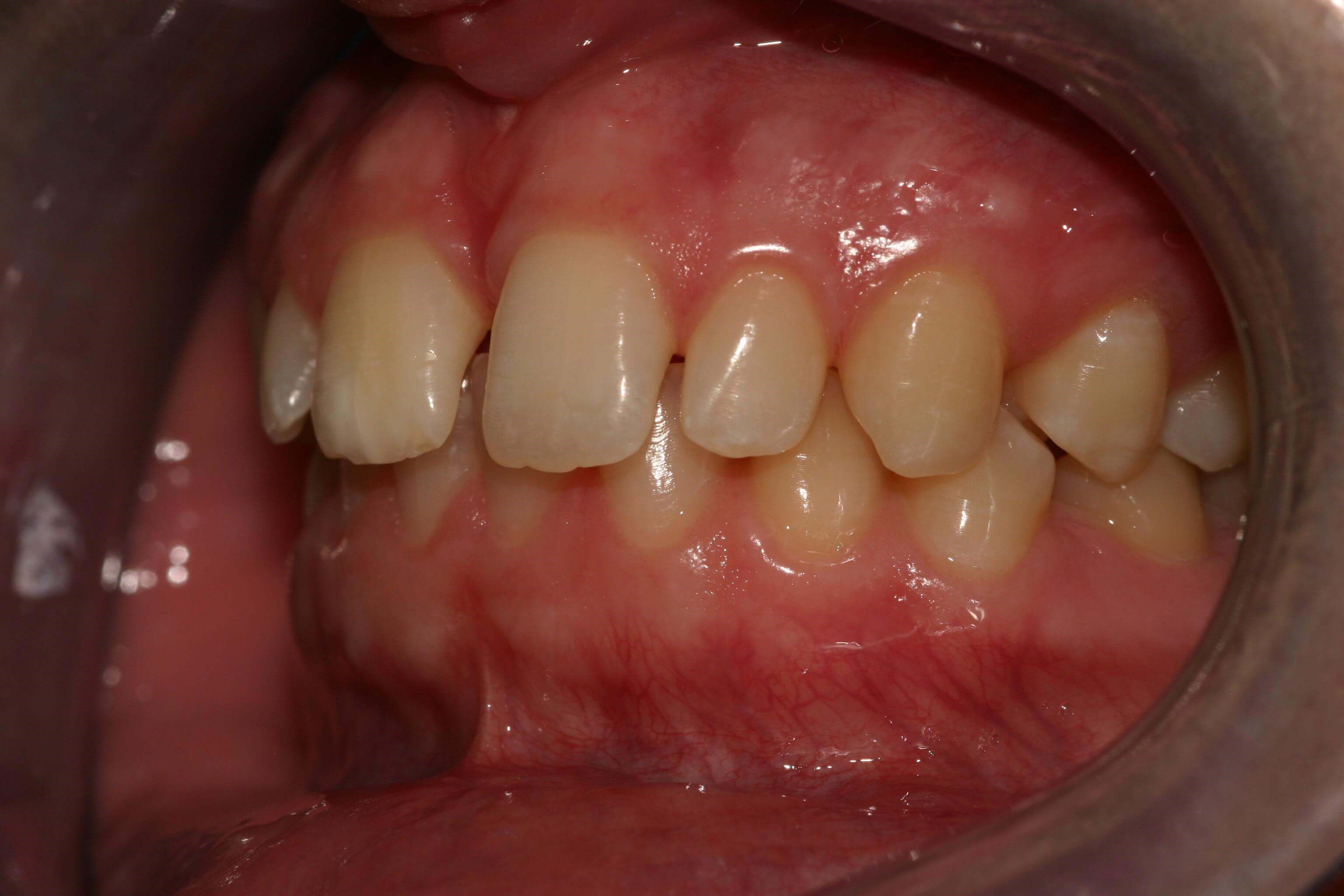 Retracted Left View Before