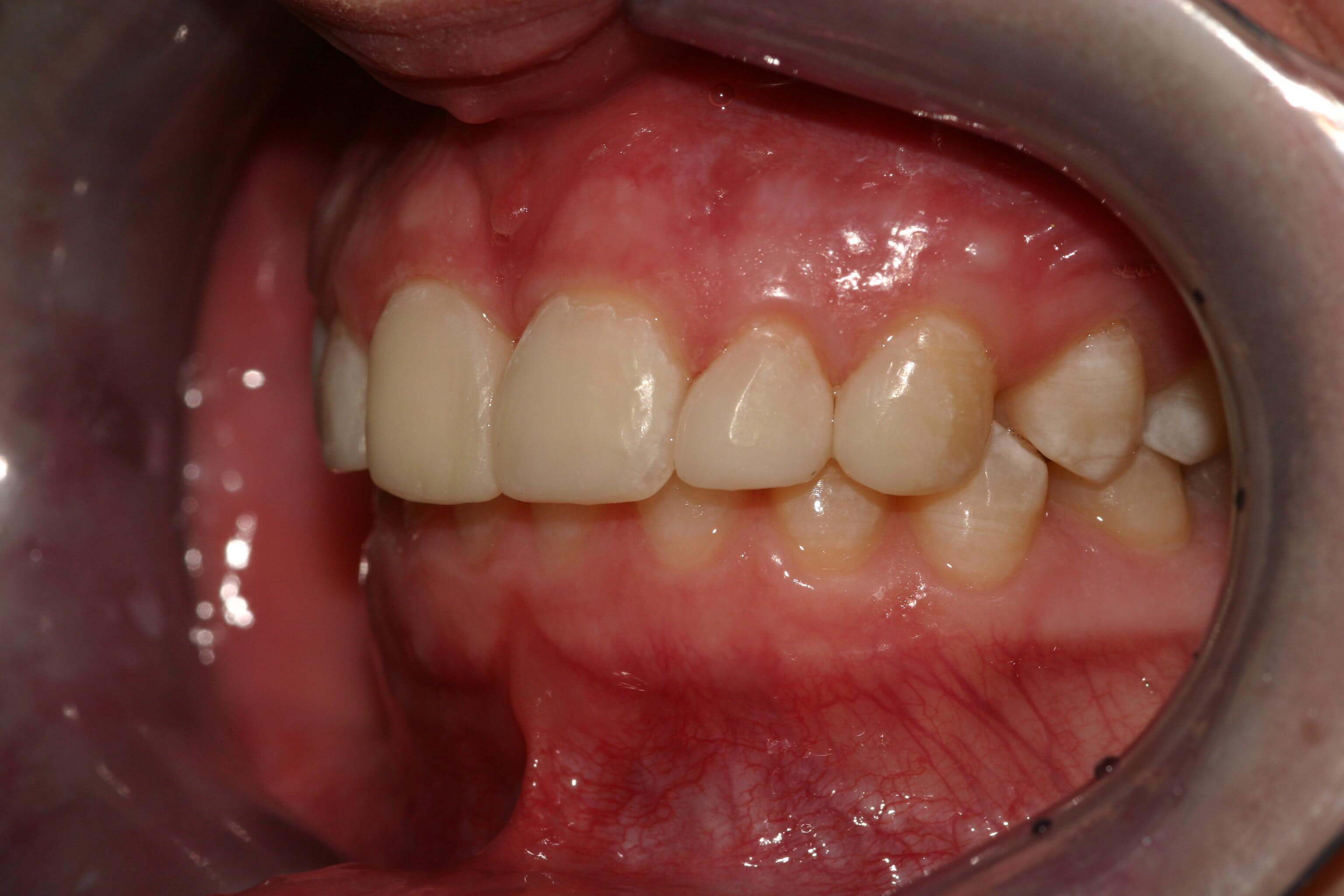 Retracted Left View After