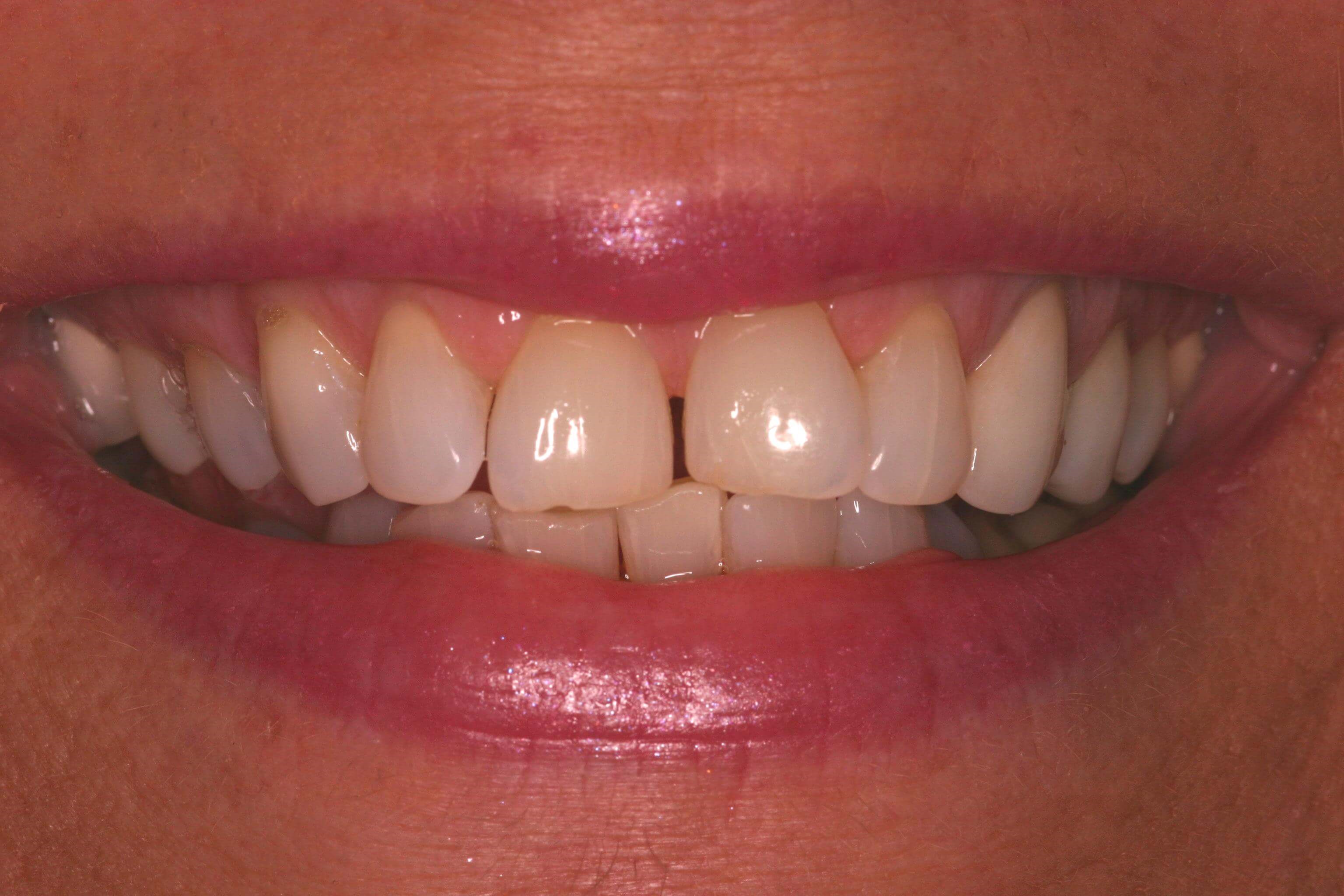 Smile Makeover Before
