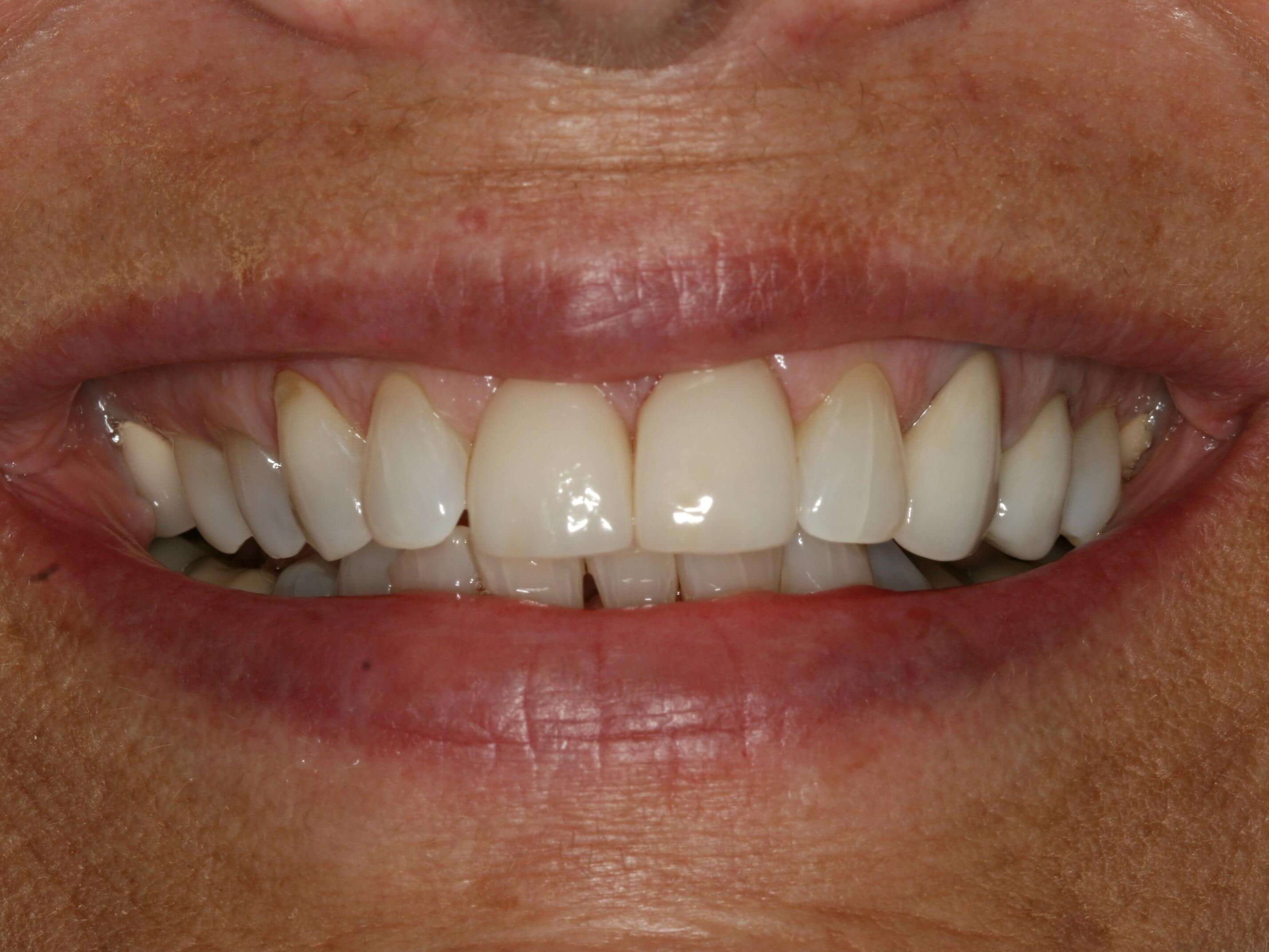 Smile Makeover After