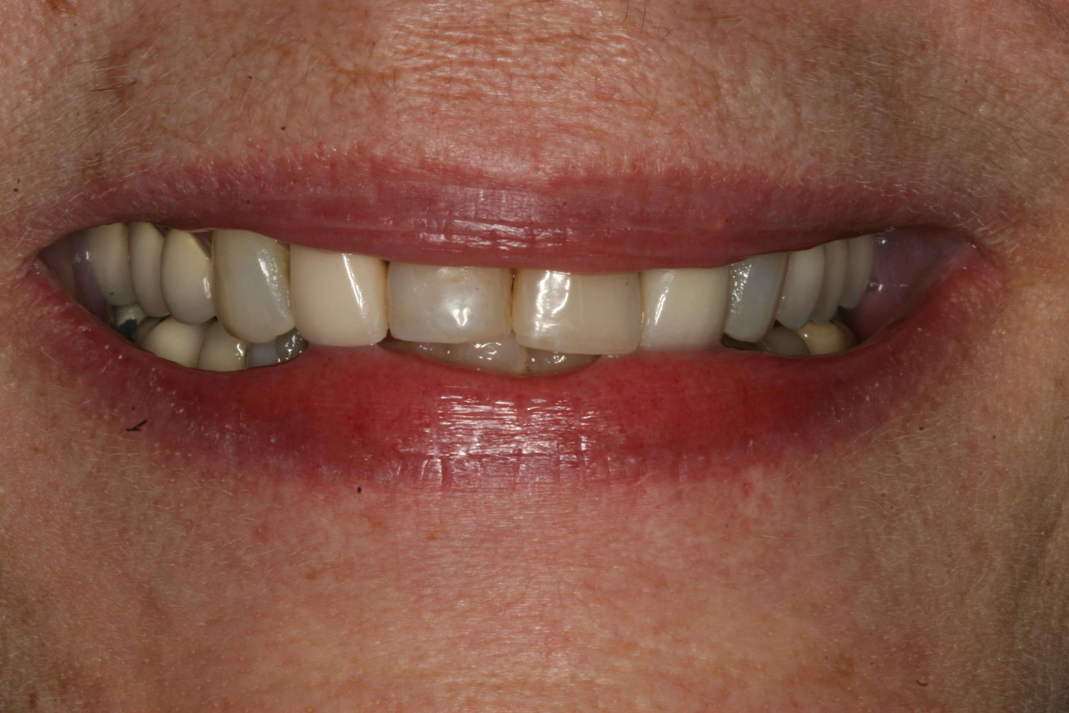 Before view of smile and teeth Before