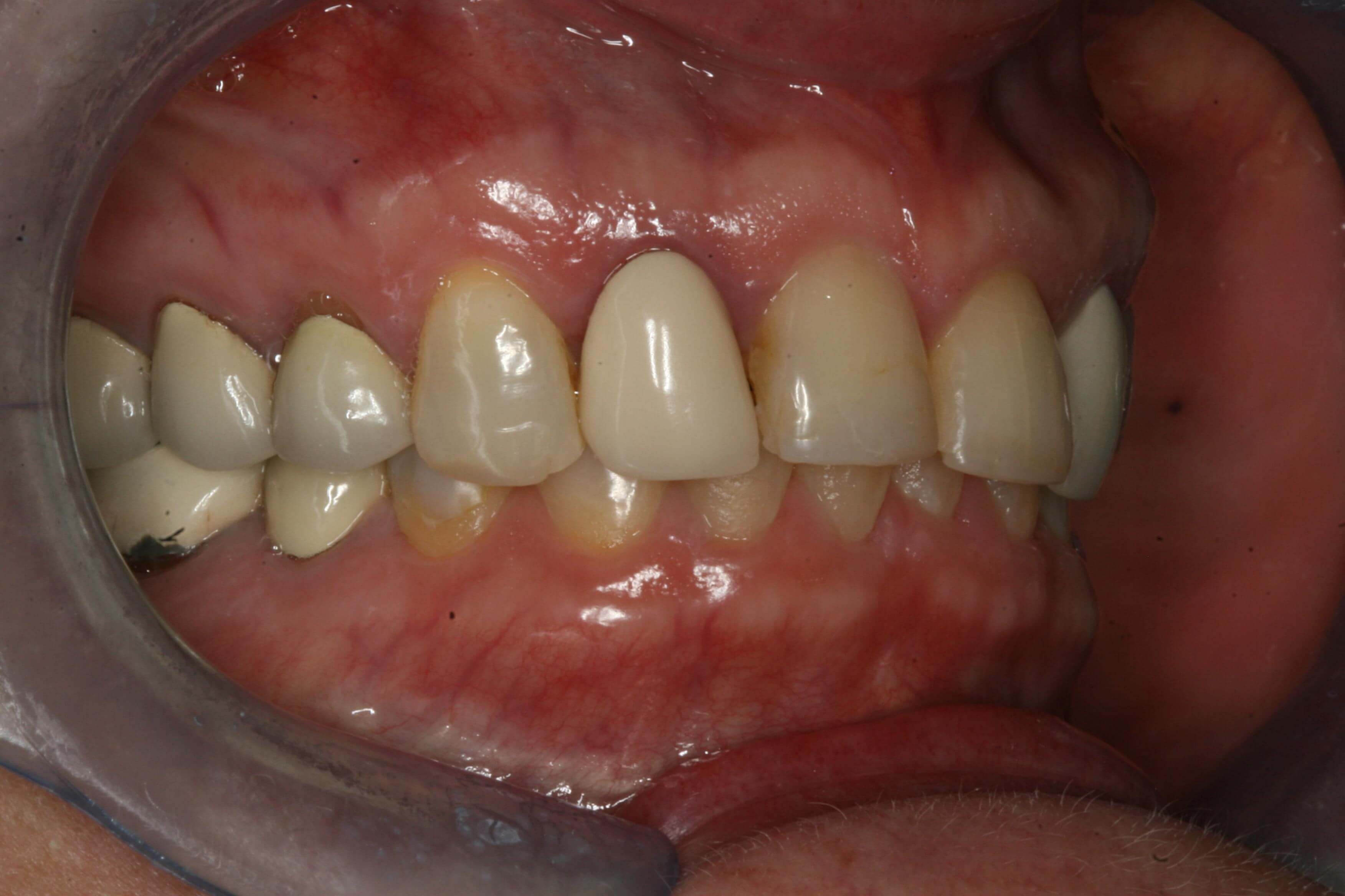 Before Right and Left Closed Before Right