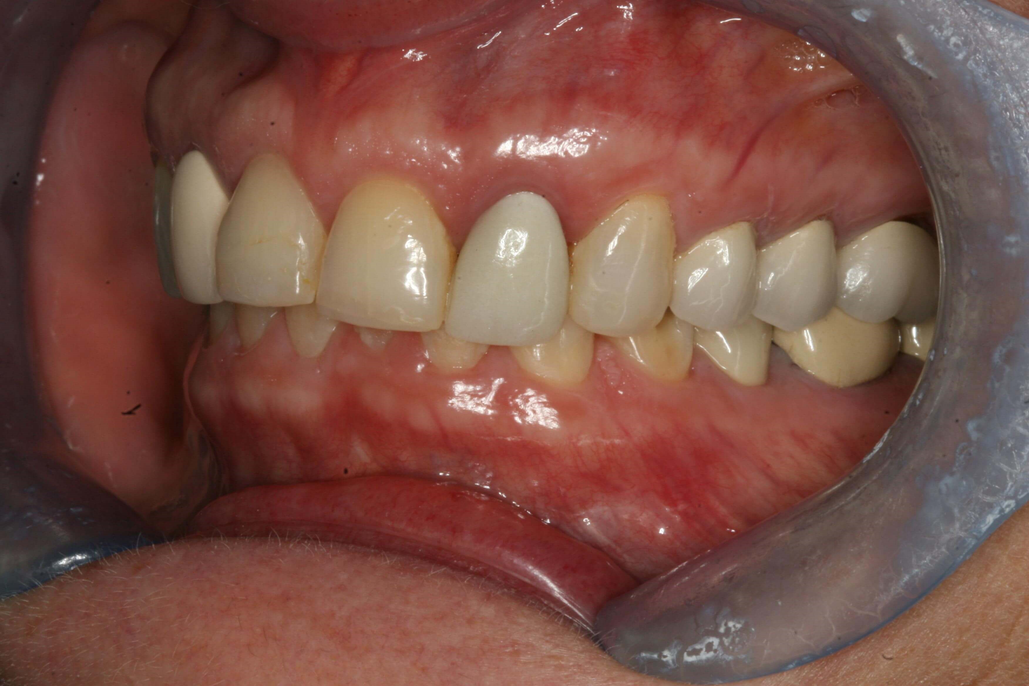 Before Right and Left Closed Before Left