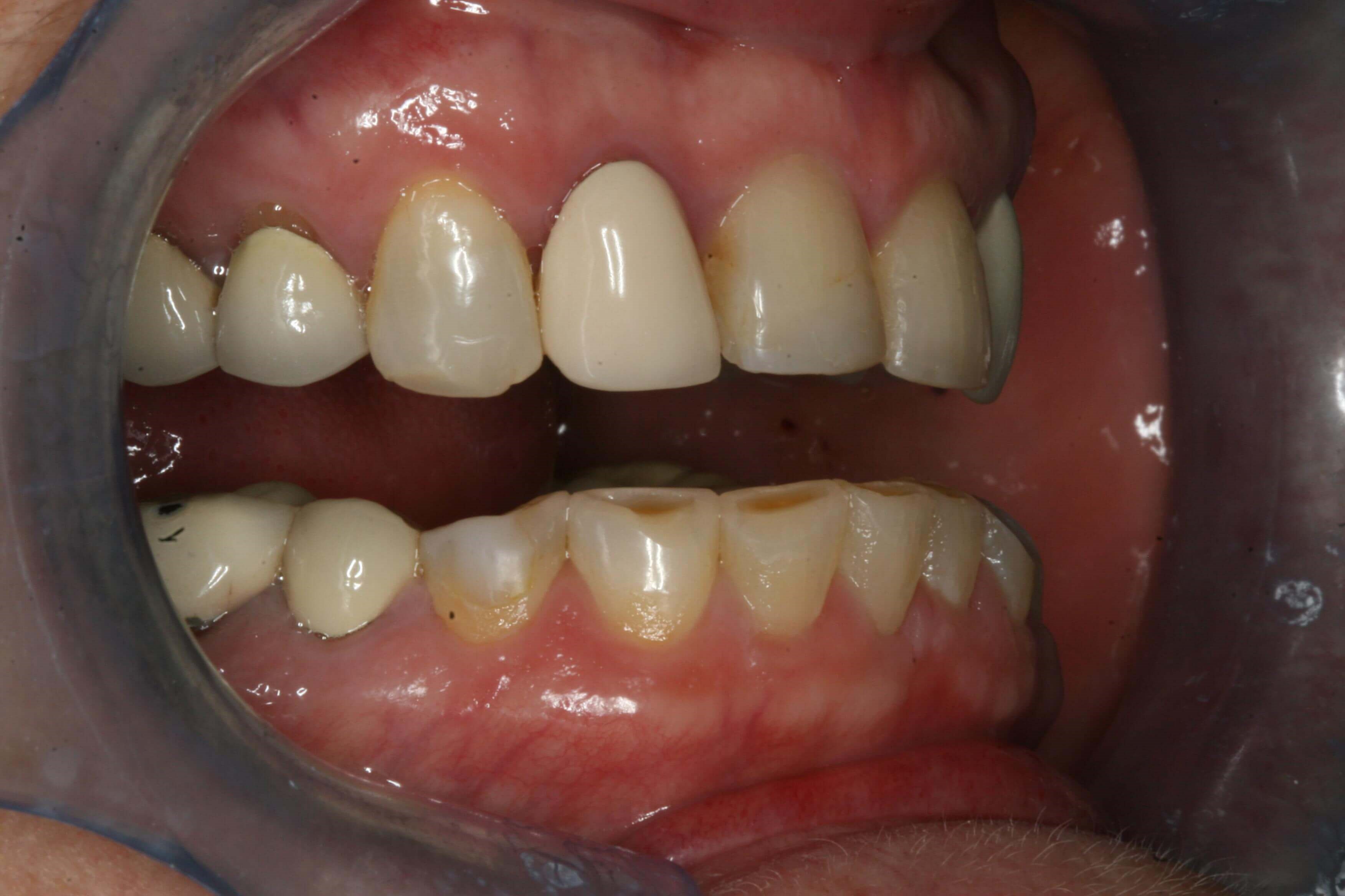 Before Right and Left Open Before Right