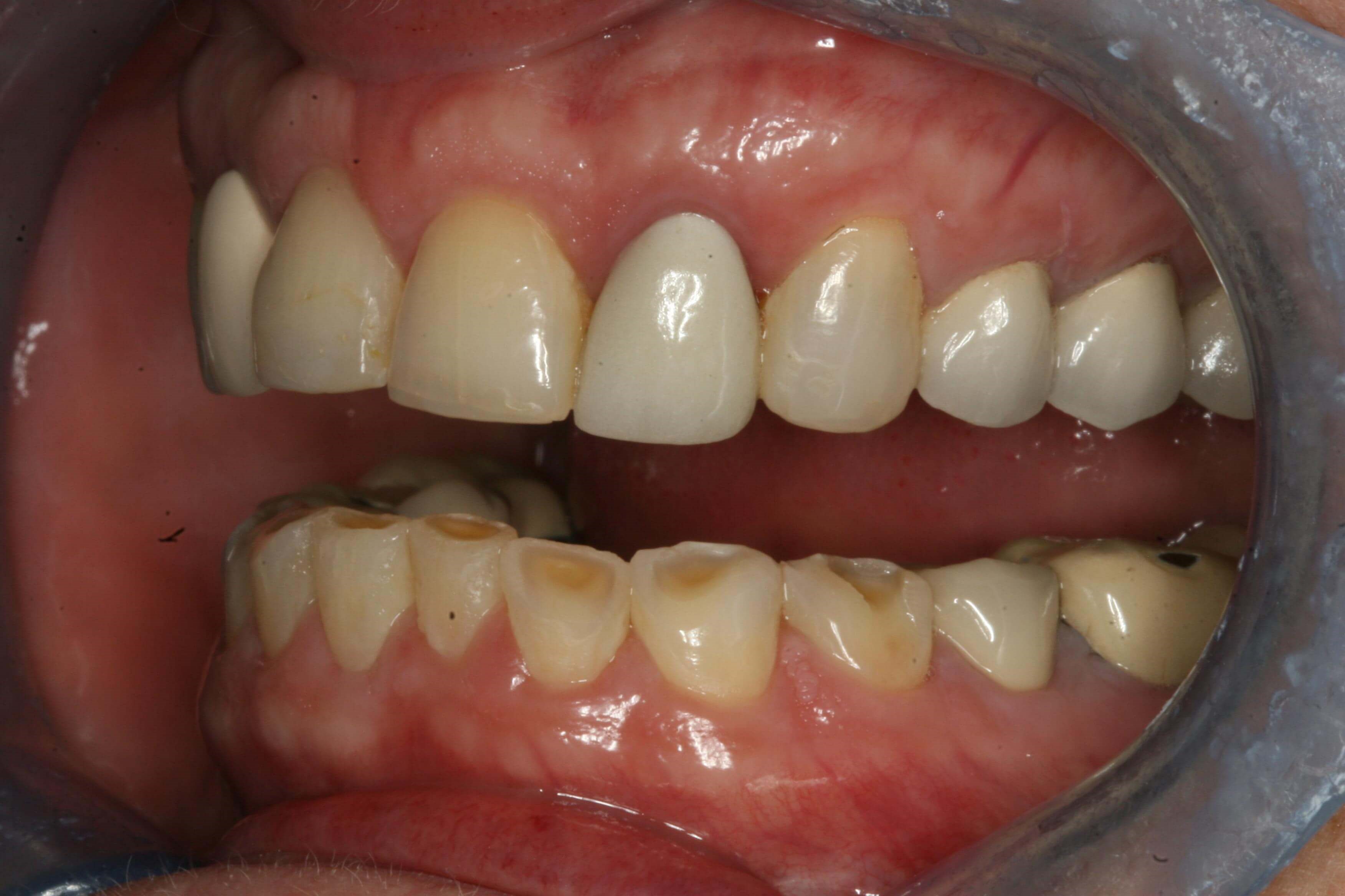 Before Right and Left Open Before Left